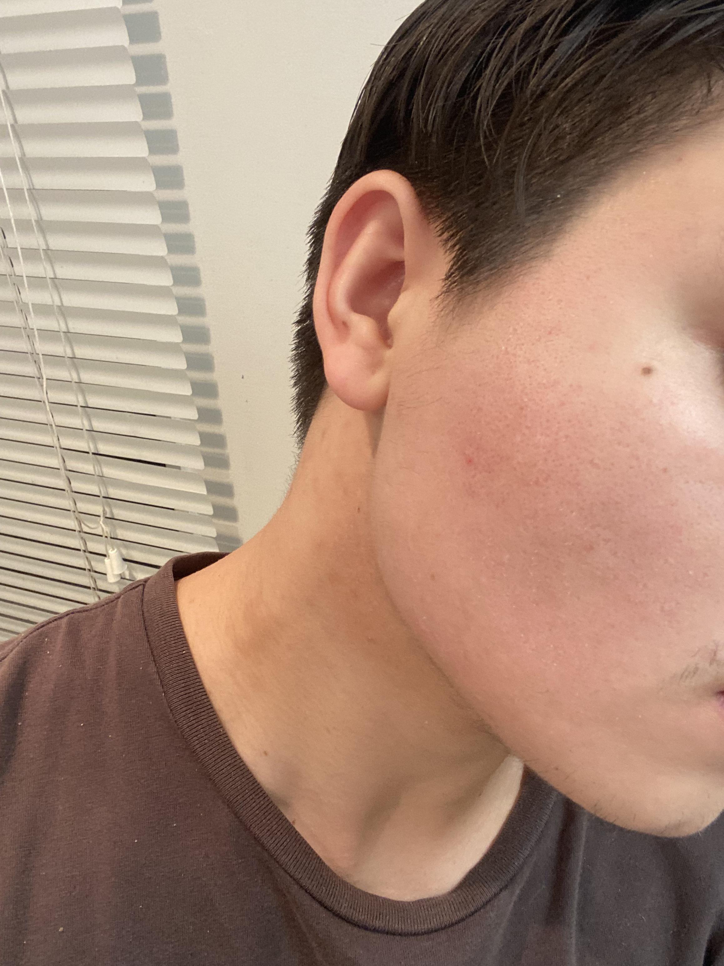 Severe acne left behind PIE. Any suggestions to remove redness? Little