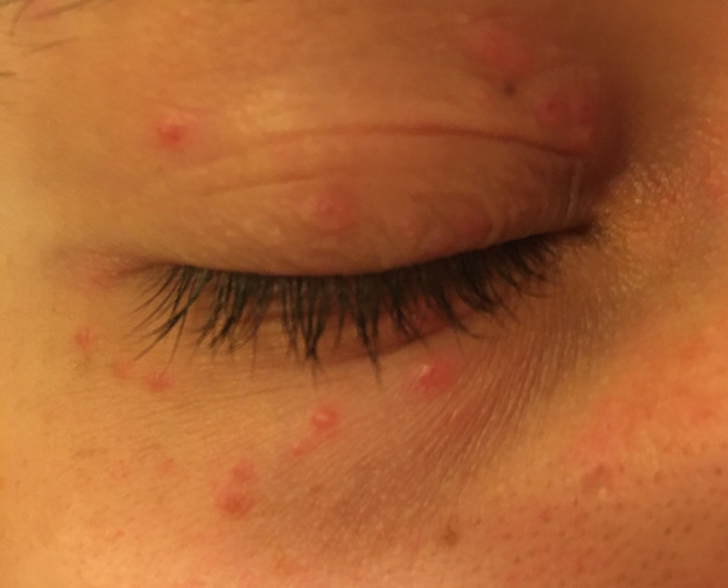 Red Dots Around Eyes Outlet, 53% Off | Www.simbolics.cat