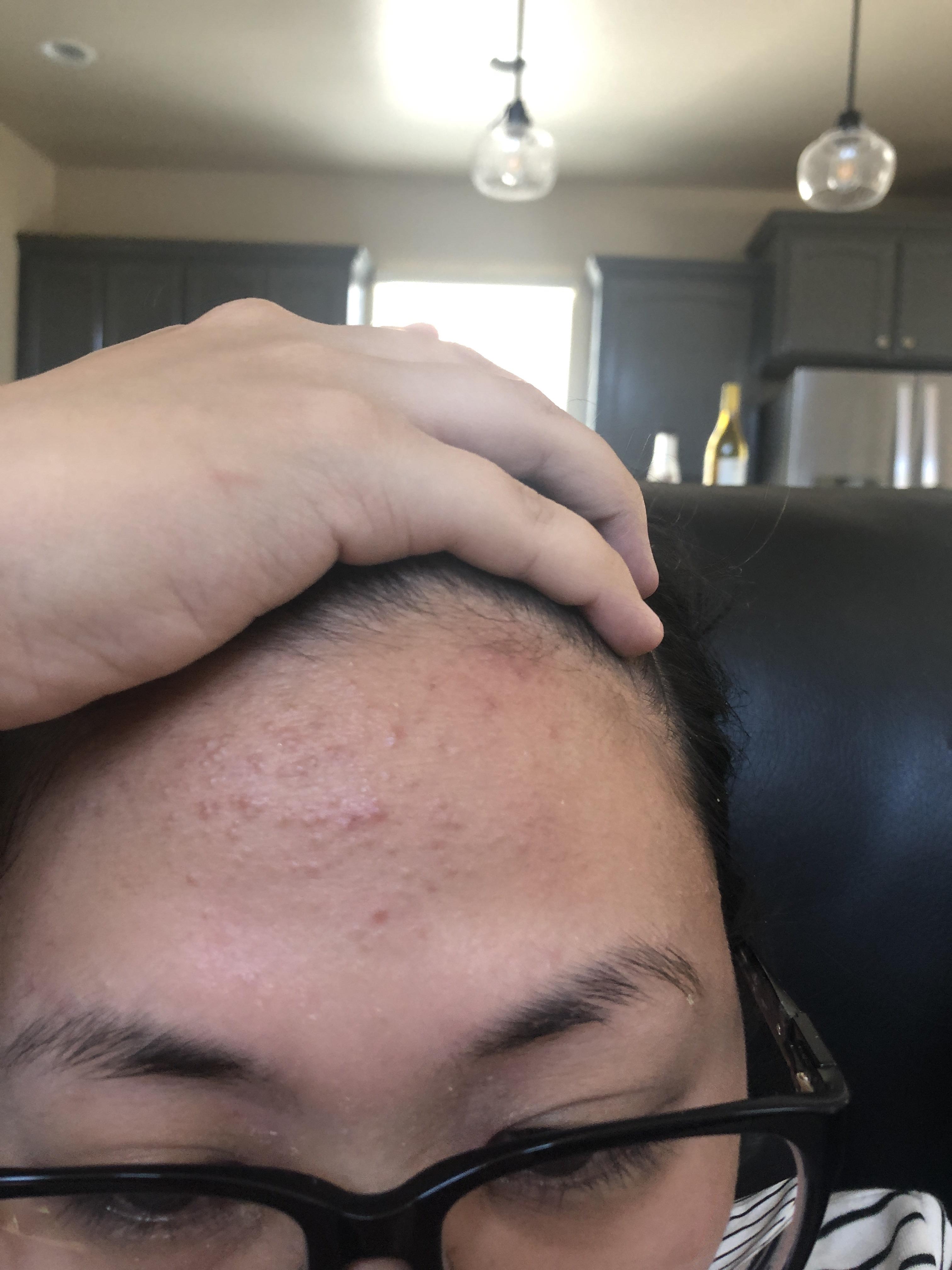 Help Acne after stopping birth control r/acne