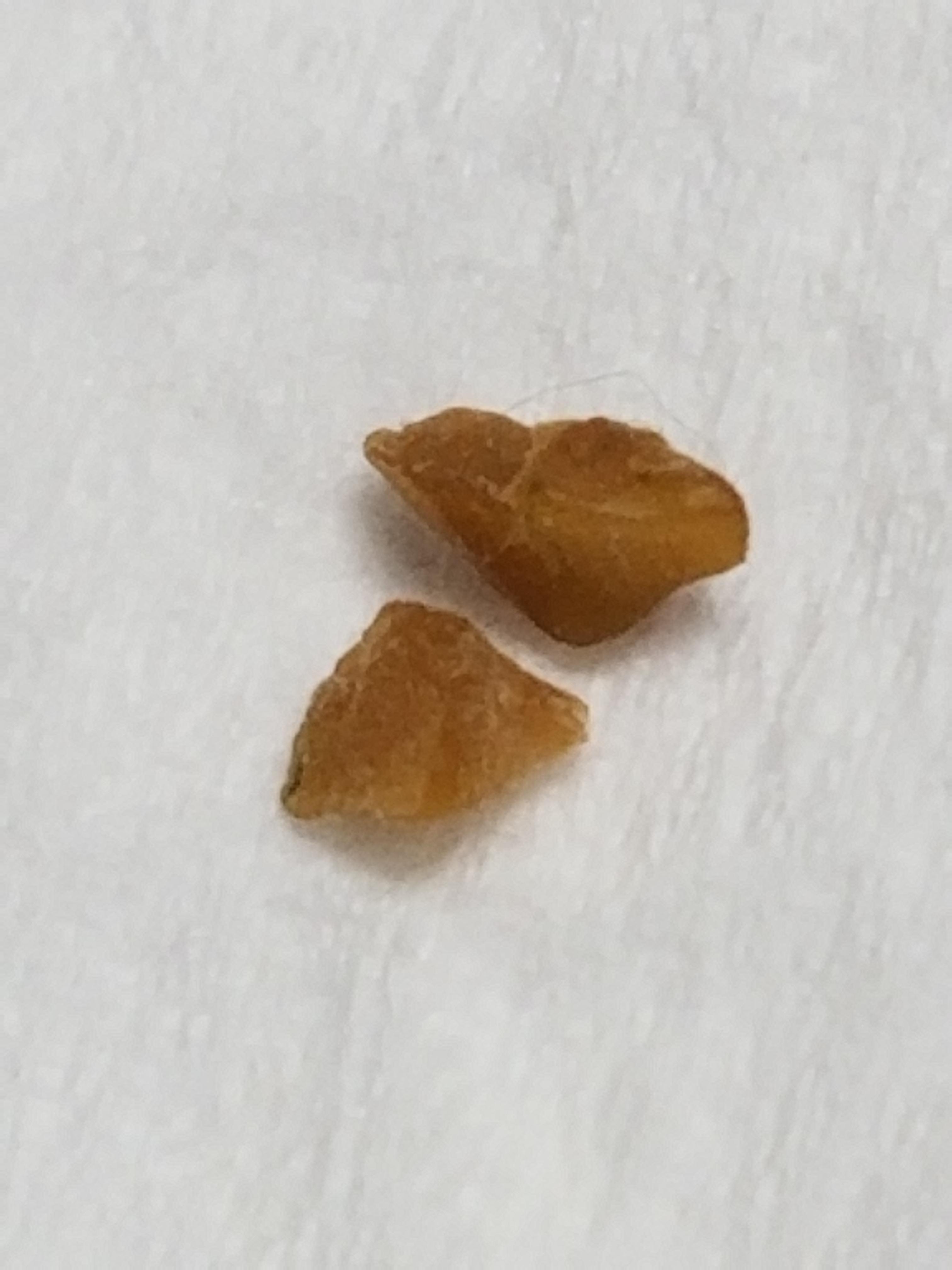 My urologist doesn't think this is a kidney stone....so wtf is it