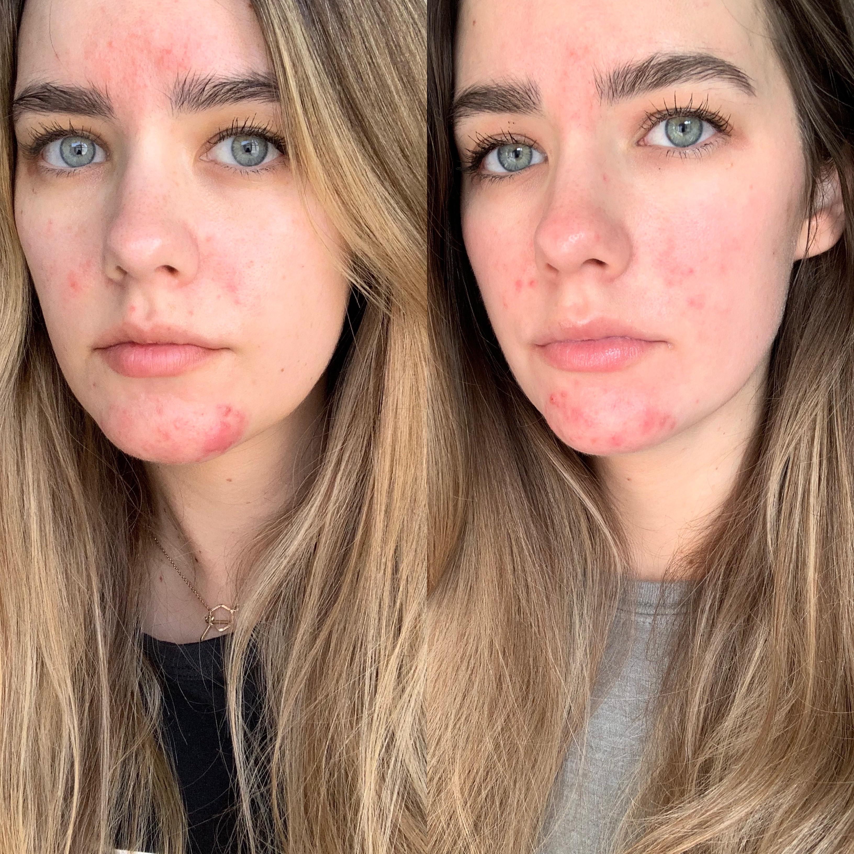 [b&a] 6 months on tret (.025 and .05) 3 months on spiro and I still don