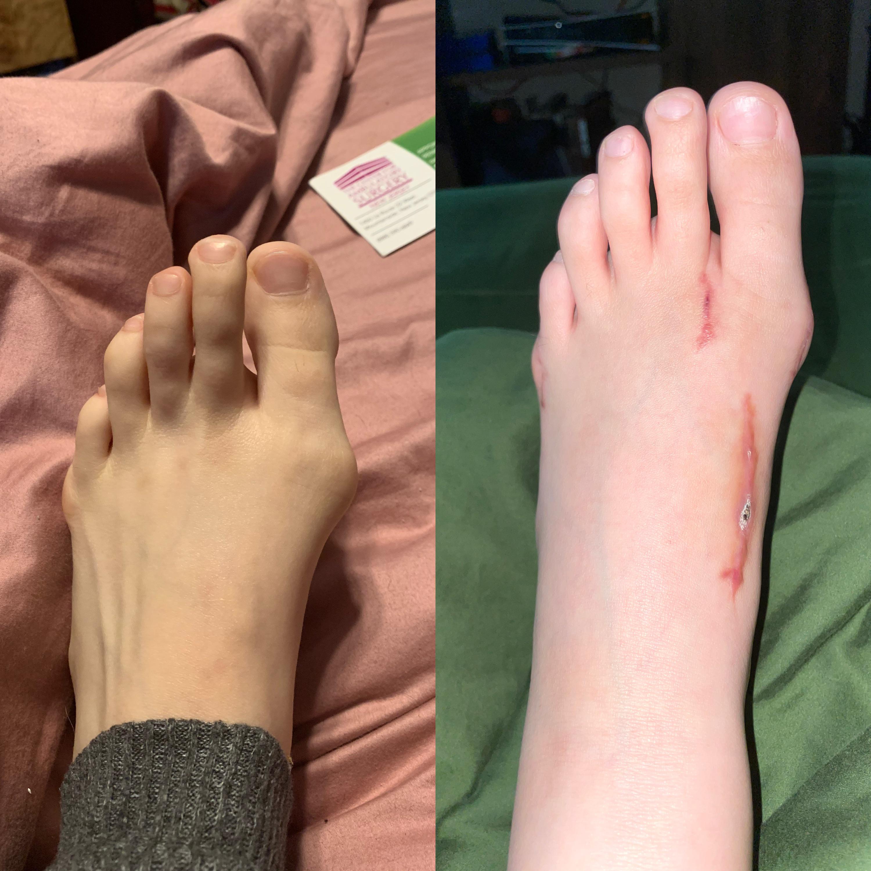 Am I crazy or does it look like my bunion is coming back?? I got my