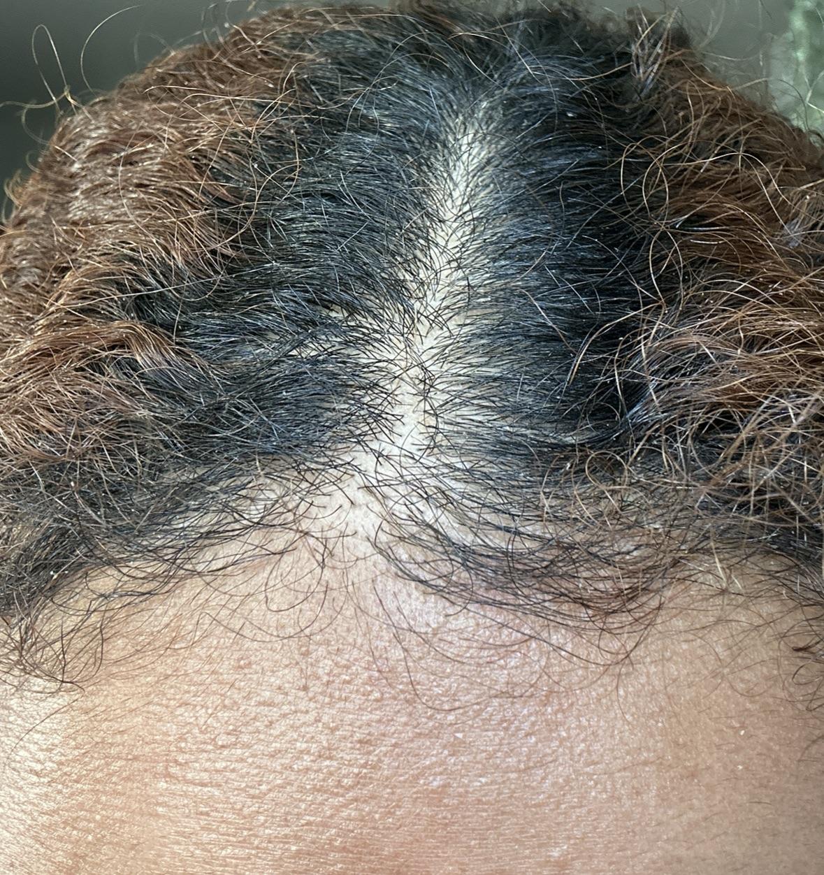 How to fix thinning hair at hairline r/Haircare