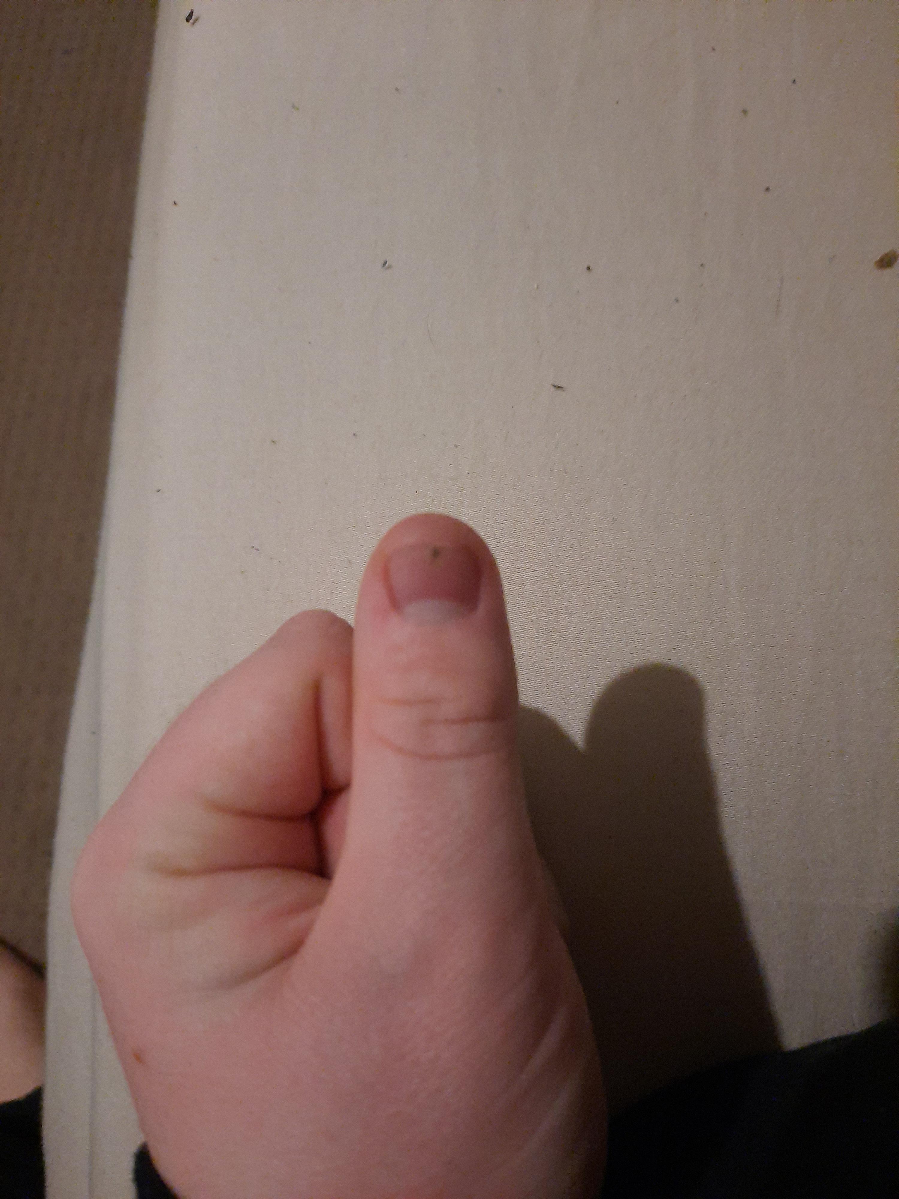 This black spot appeared out of nowhere on my left thumb's nail. Hurts