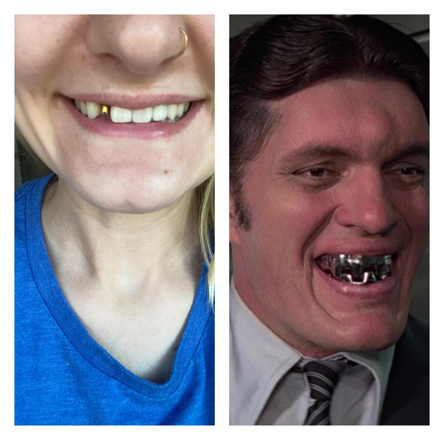 My tooth implant fell off last night, one tooth closer to looking like