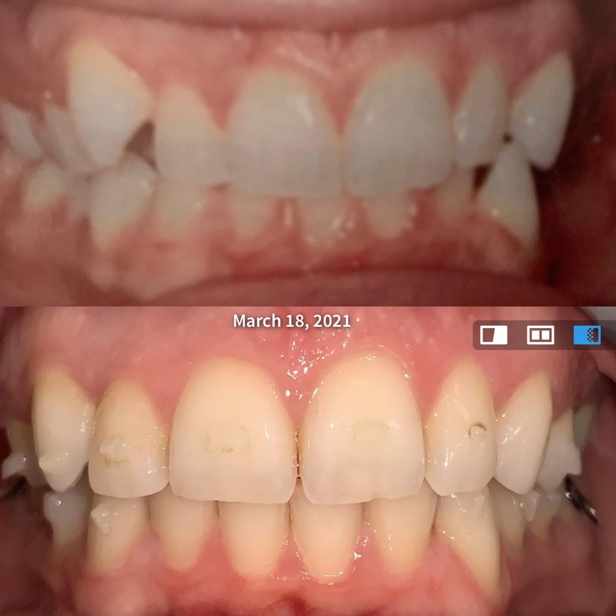 How to Tell if Your Invisalign Trays Fit Correctly –.