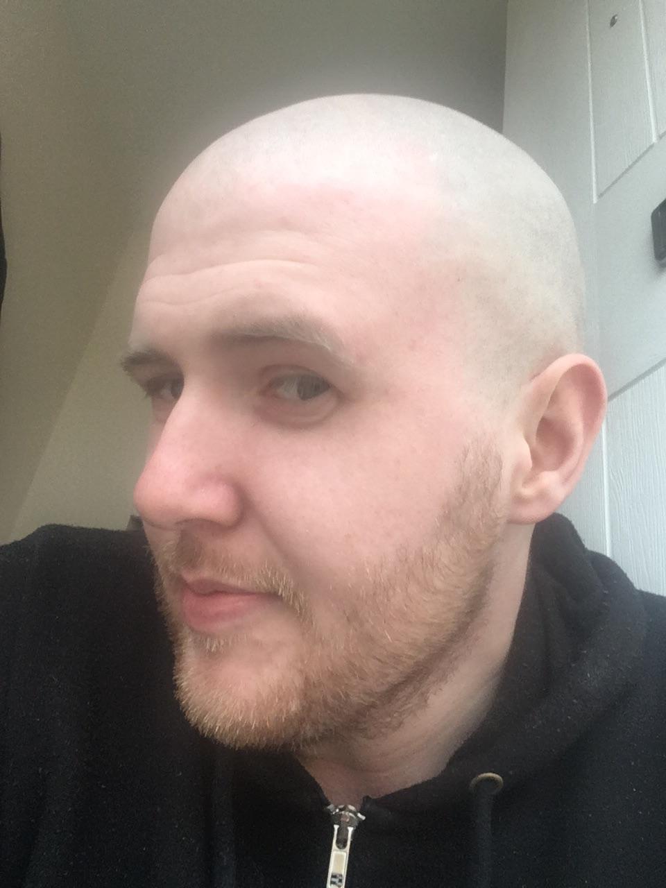 Been balding for past two years but buzzed with no guard for like six, first ever razor shave in