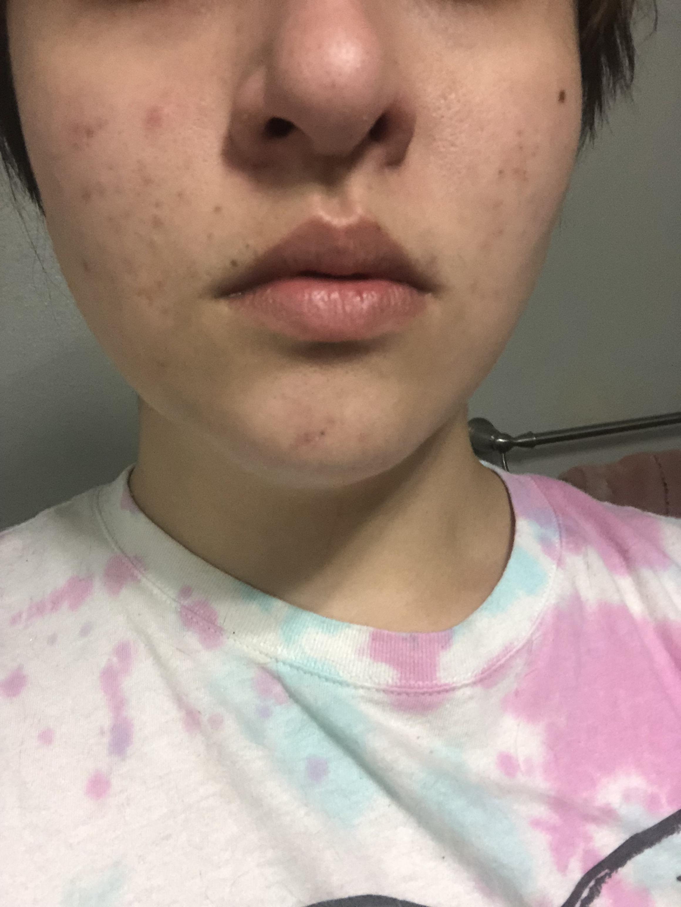 [Acne] Congested skin and clogged pores, what’s causing it? r