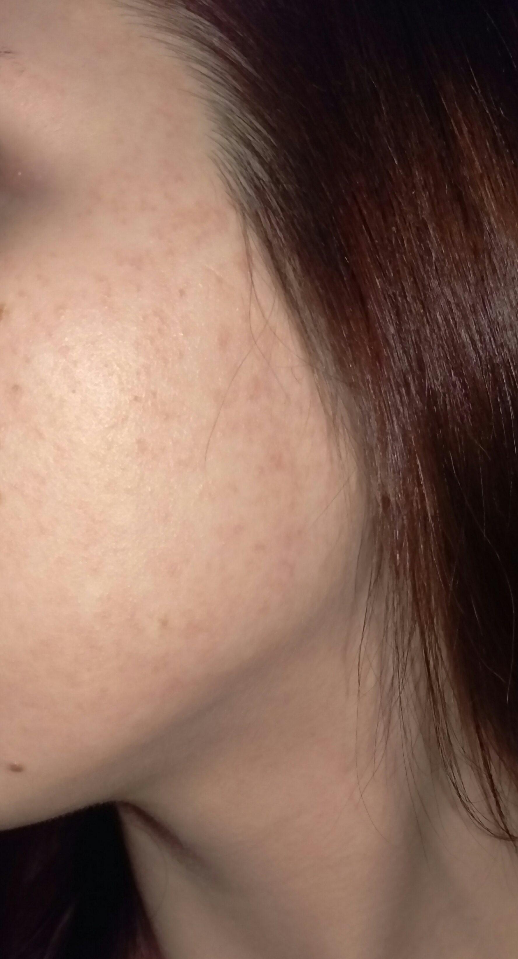 Red Dots On Face Skin Bumps That Look Like Pimples But Aren T What