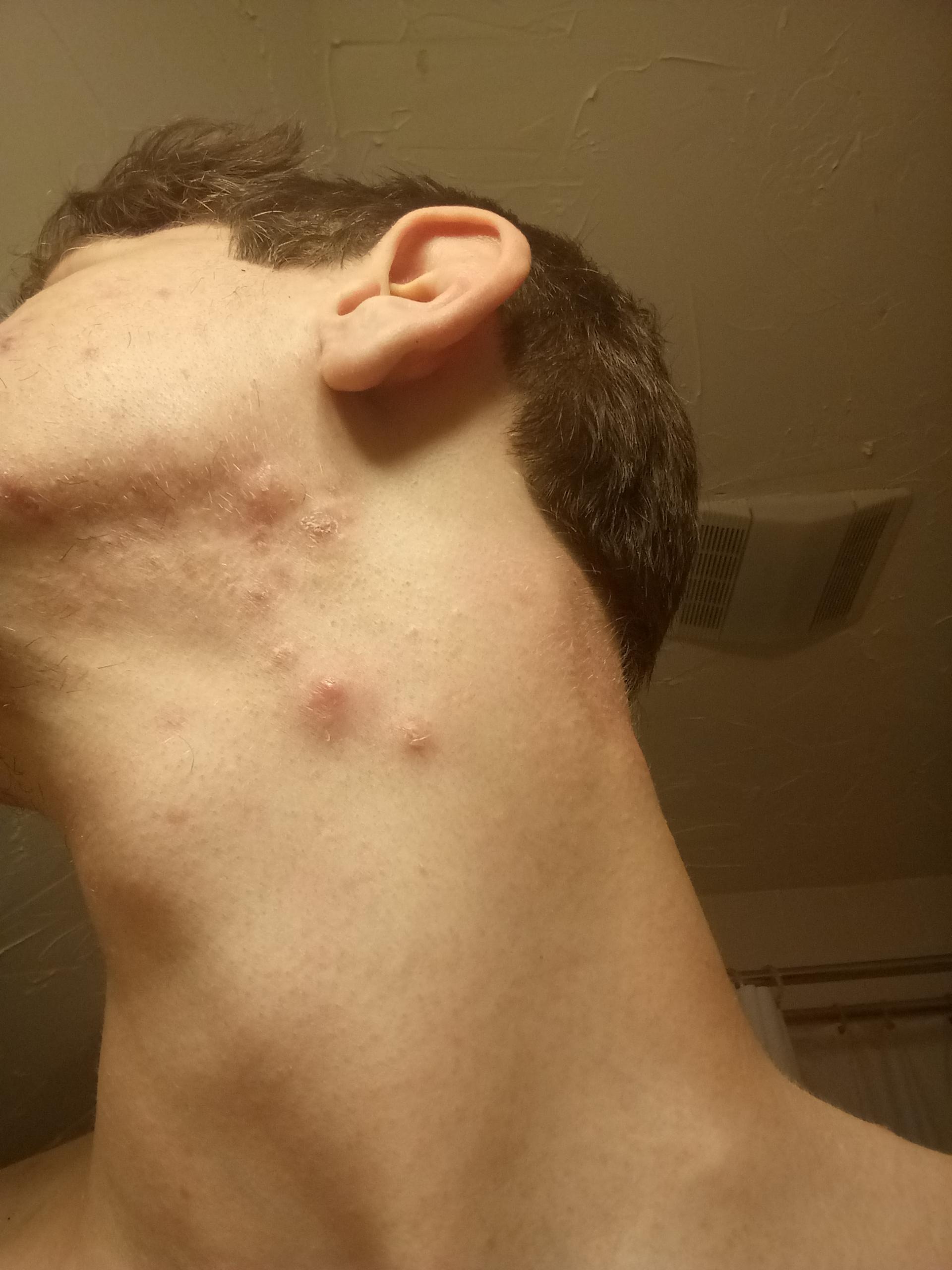 [Acne] 18 year old male, and I get cystic acne in the same