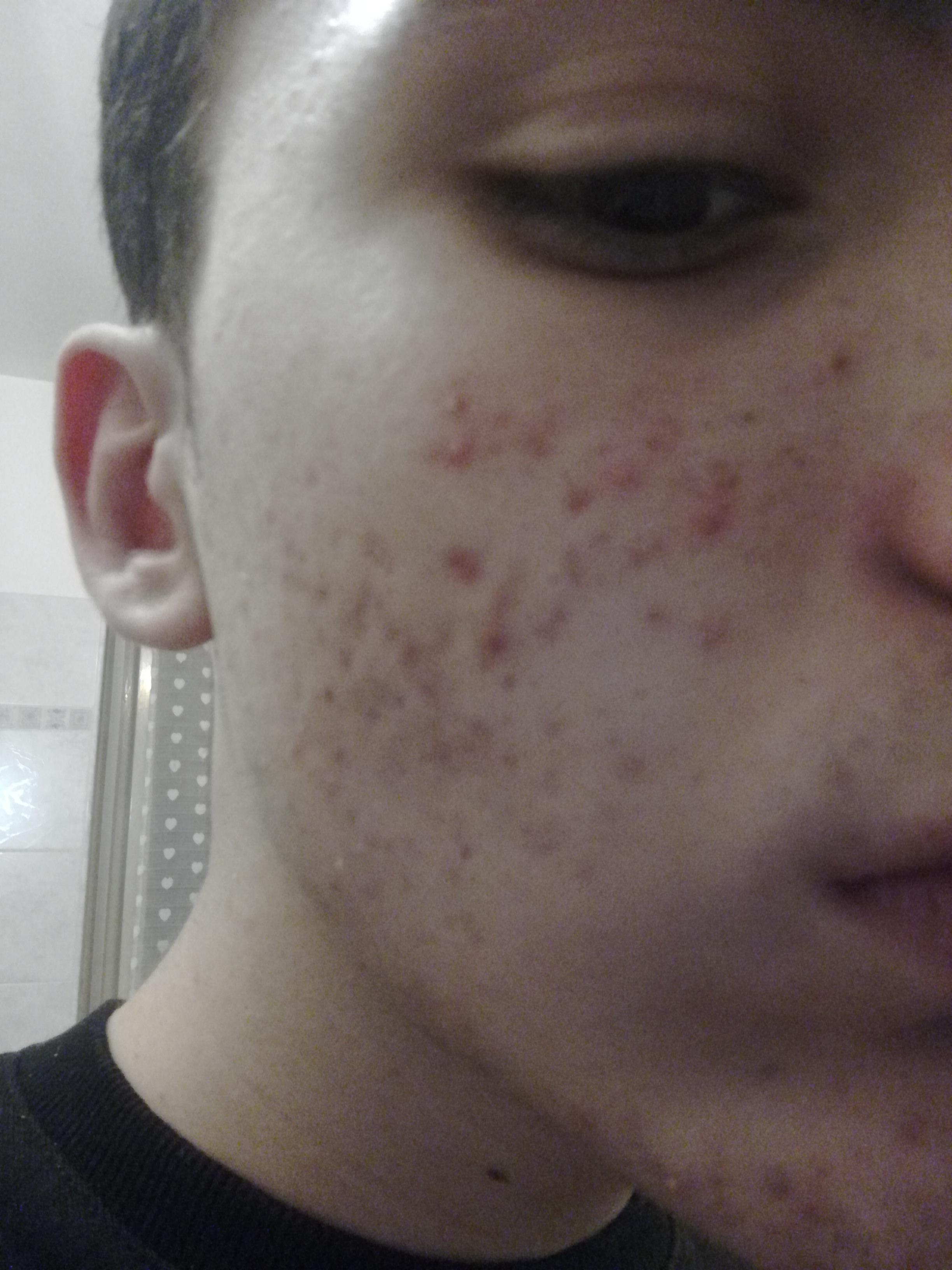 [Acne] [Help] What kind of Acne is this? Can it be PIE? How can I get
