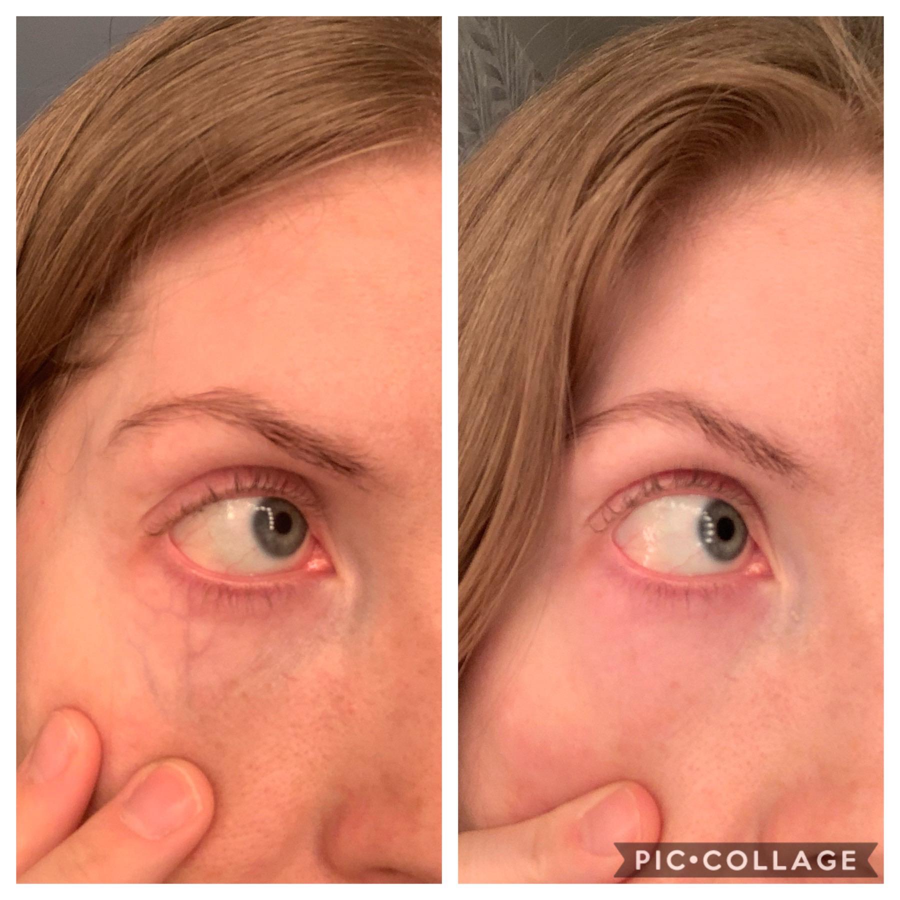 Periorbital Vein Treatment with YAG Laser before and after r