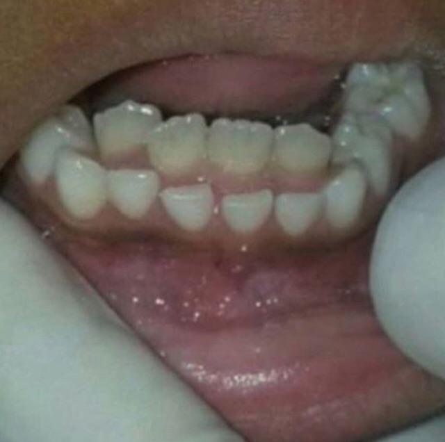 Adult teeth growing behind baby teeth. (I actually had something like
