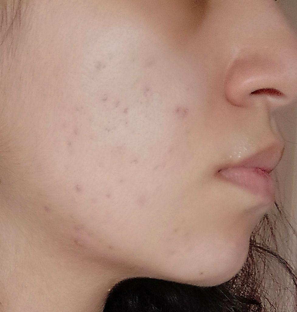 [Routine help] Cystic acne kind of under control with azelaic acid