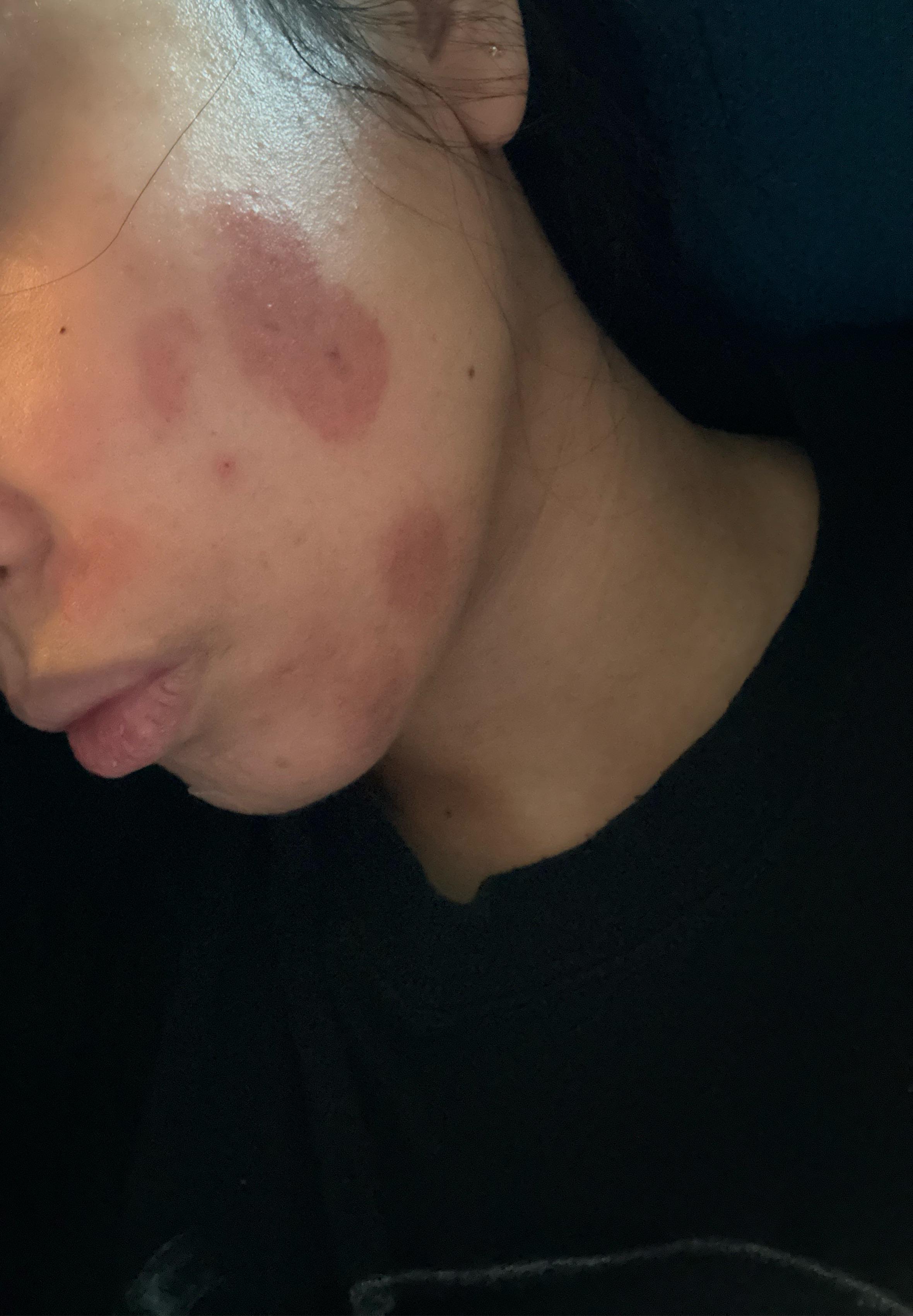 Help me. Chemical burns. How to remove? Would it scar? 😓 r