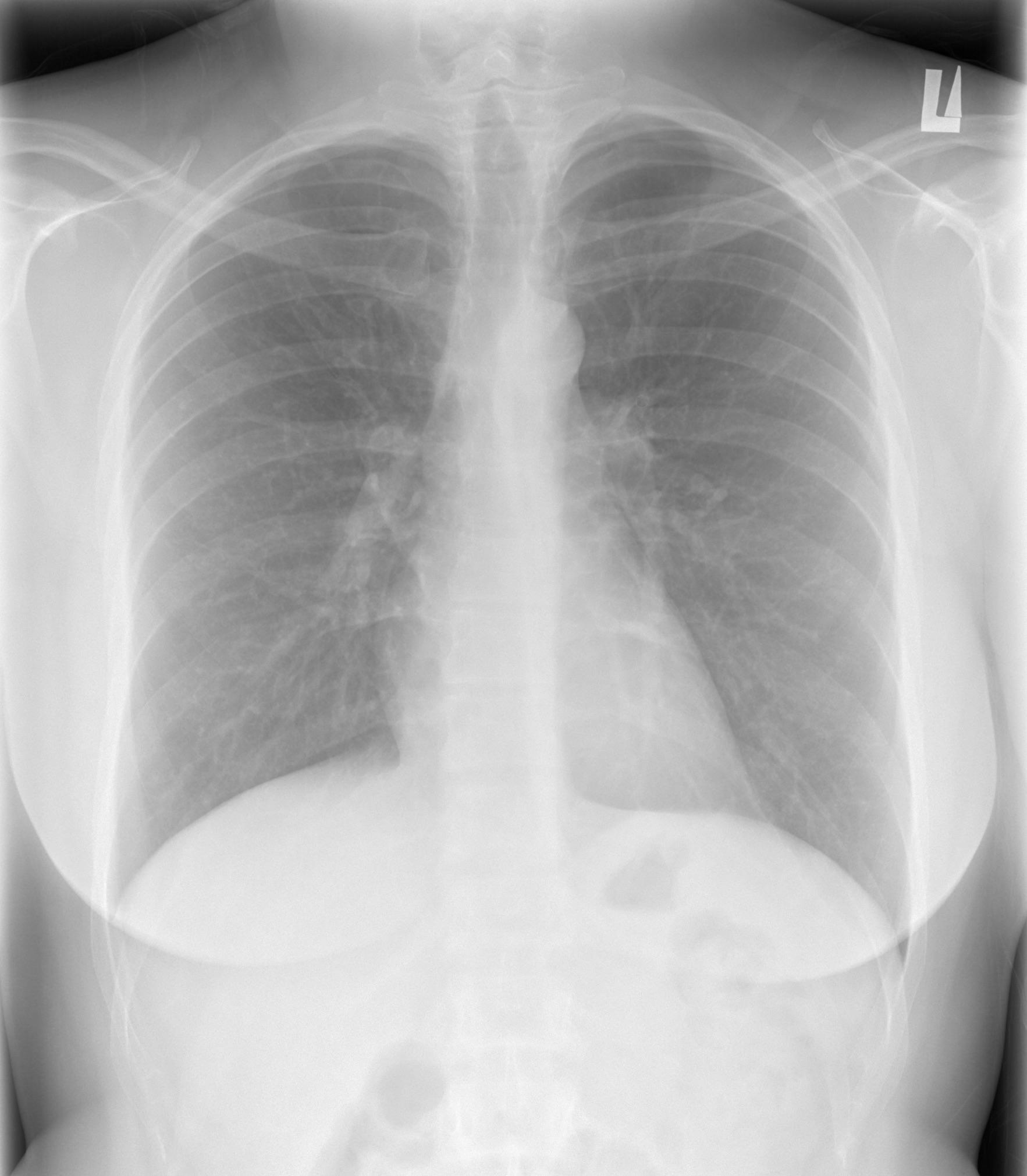 Chest XRay; please help interpret the scan. Also why is there a circle