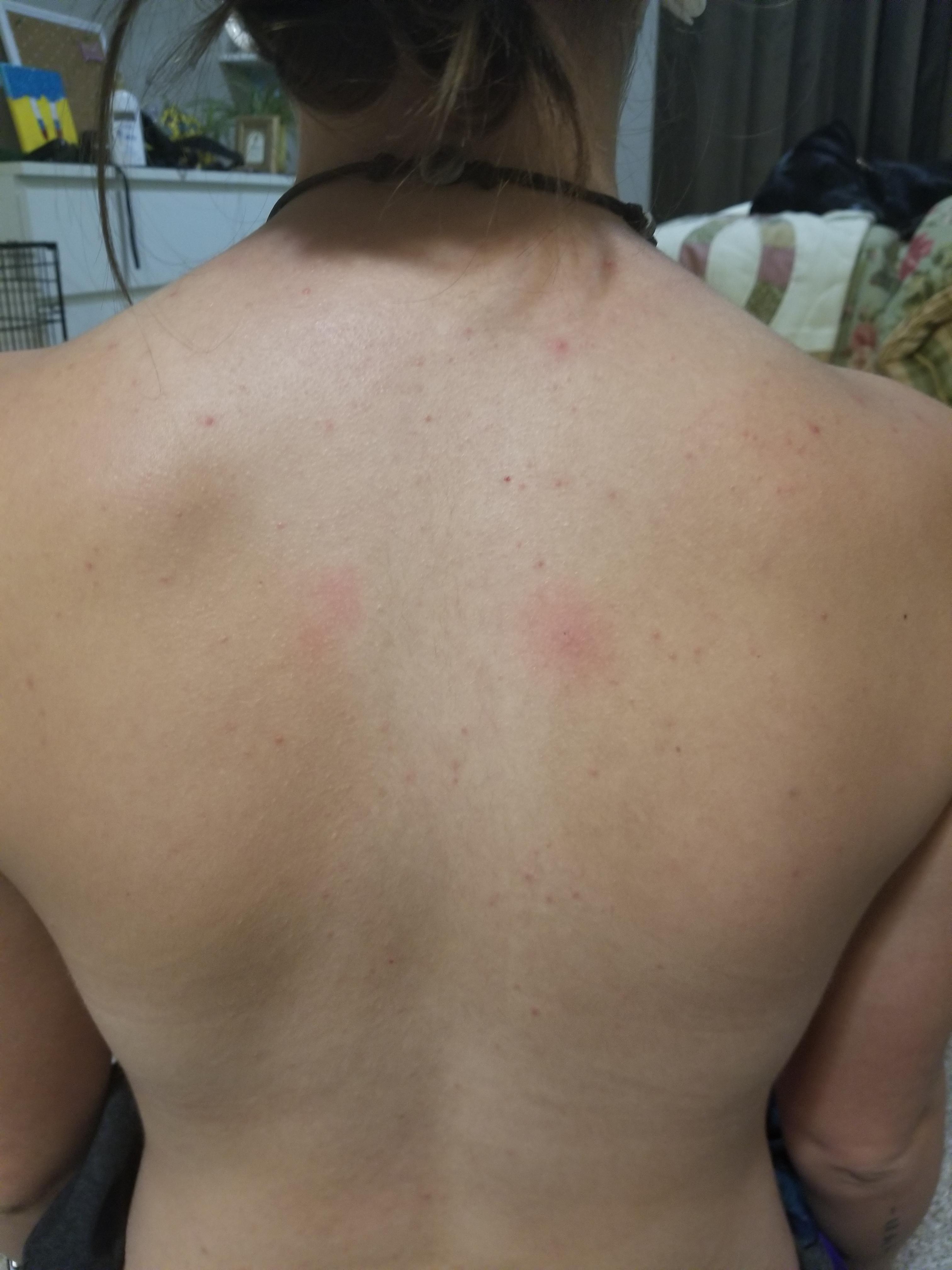 Anyone know what this is? My left shoulder blade area has a bump, bone