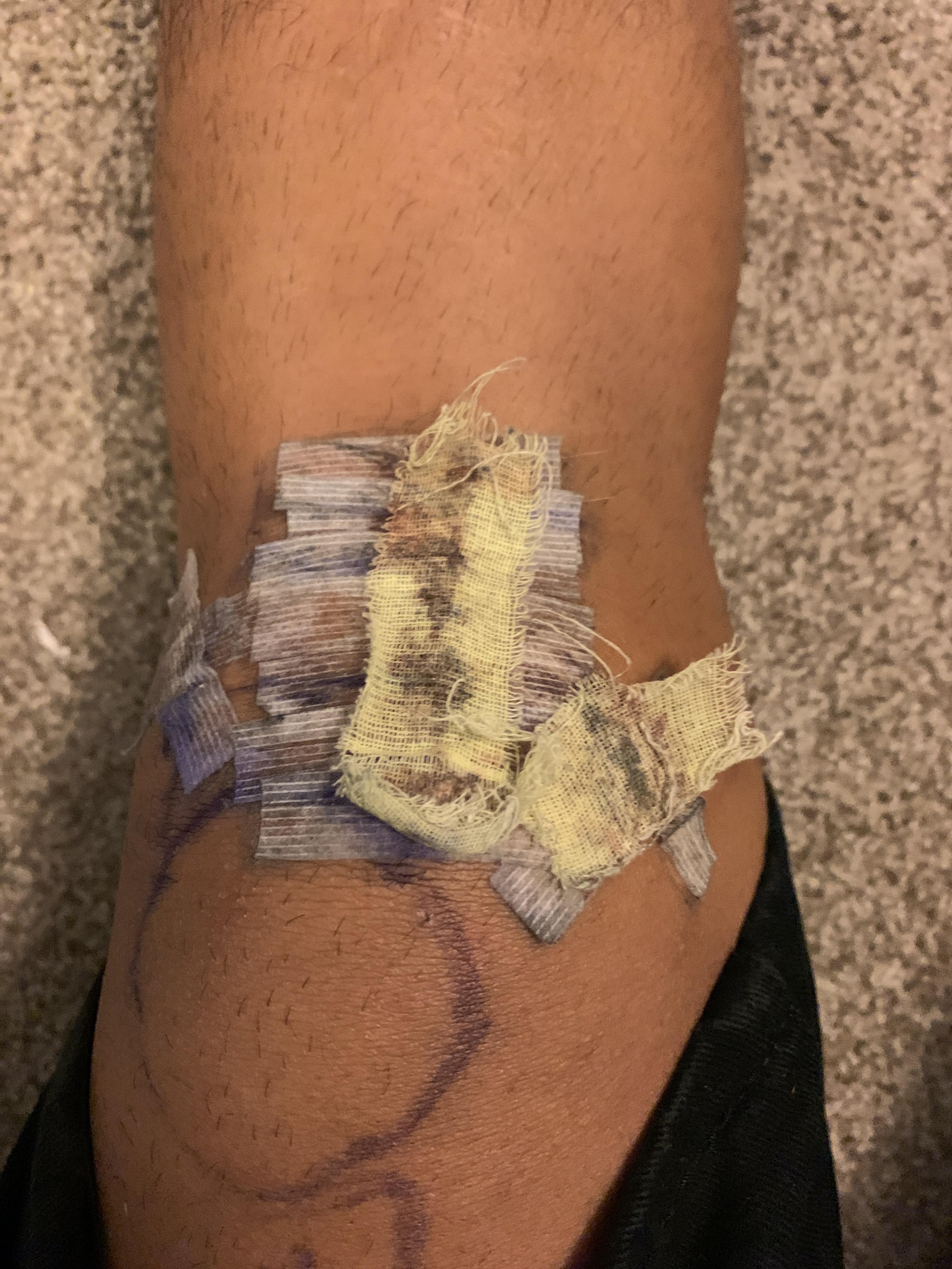 ACL suture, 10 days postop, when should I remove the bandages? r/ACL