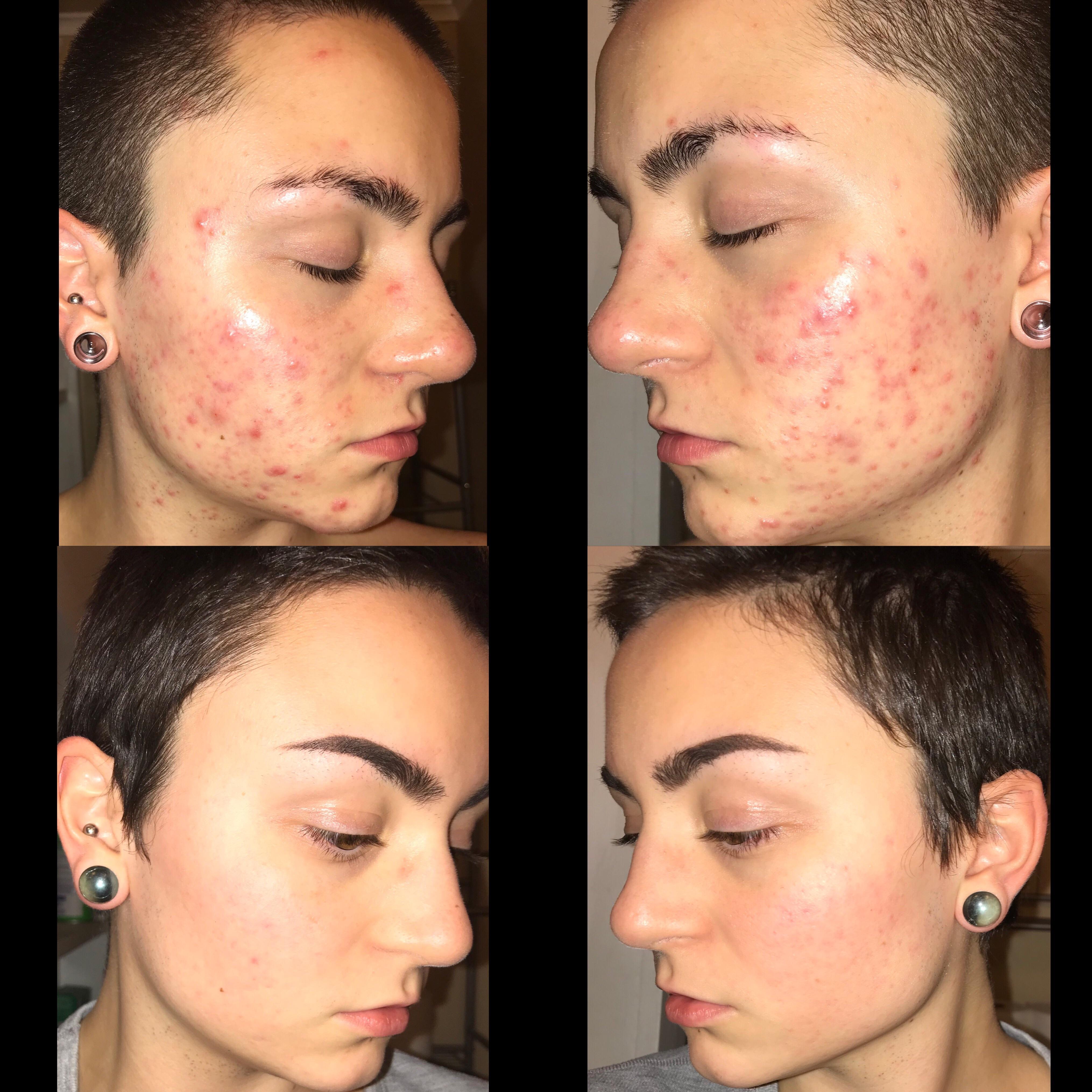 May to current. Never realized how bad my acne was until I looked at