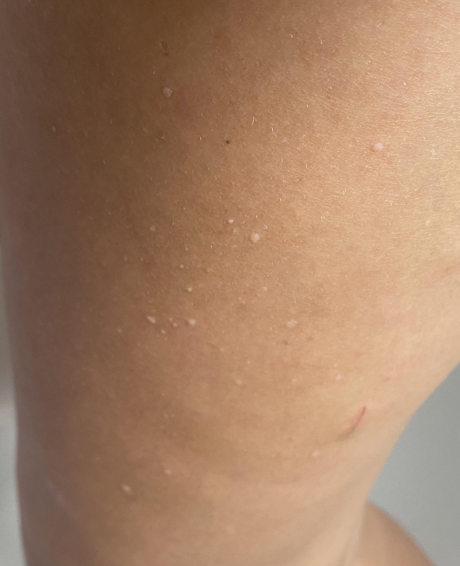 Small white raised bumps on thighs. r/DermatologyQuestions