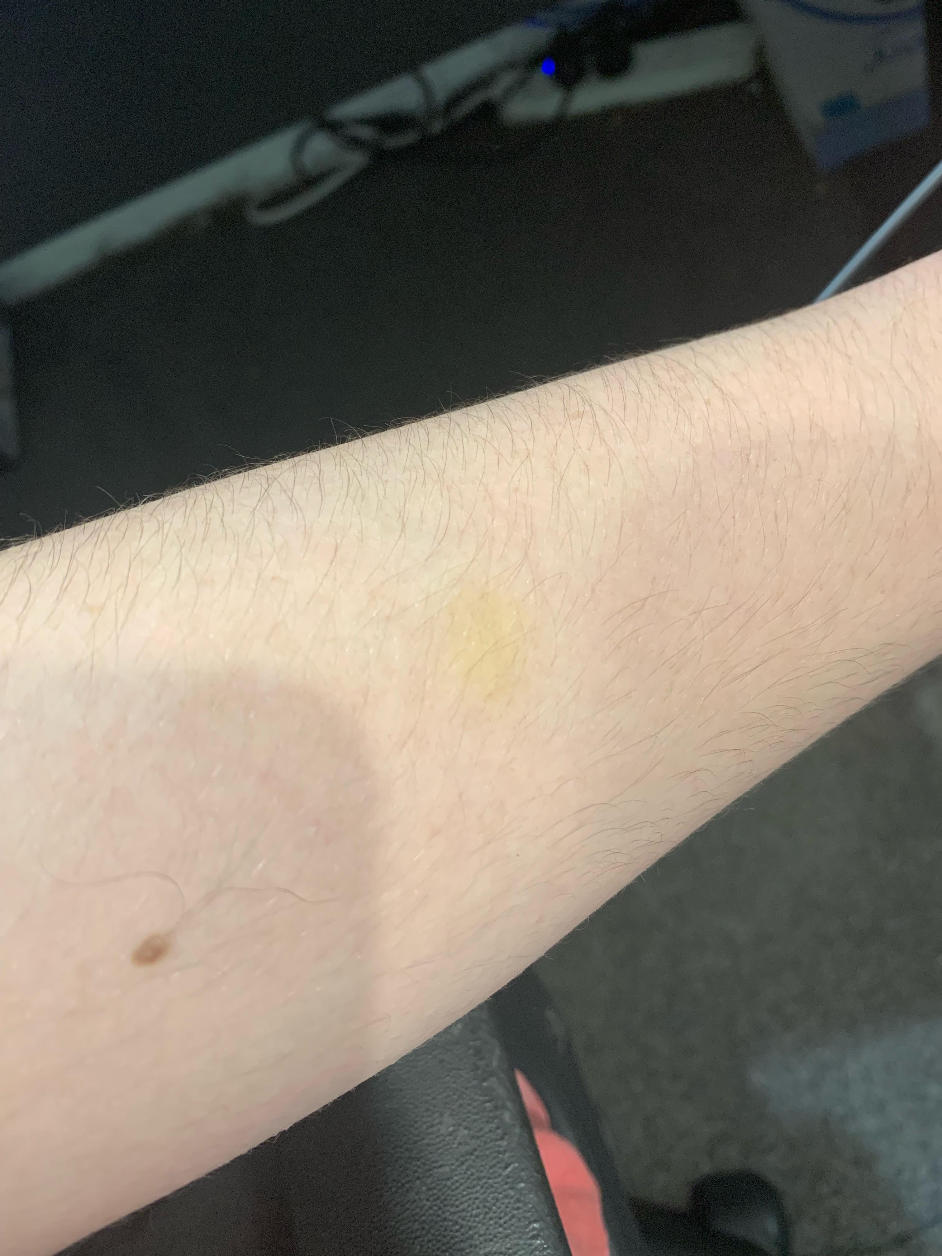 Very small yellow spot on skin, just noticed it recently, nothing feels