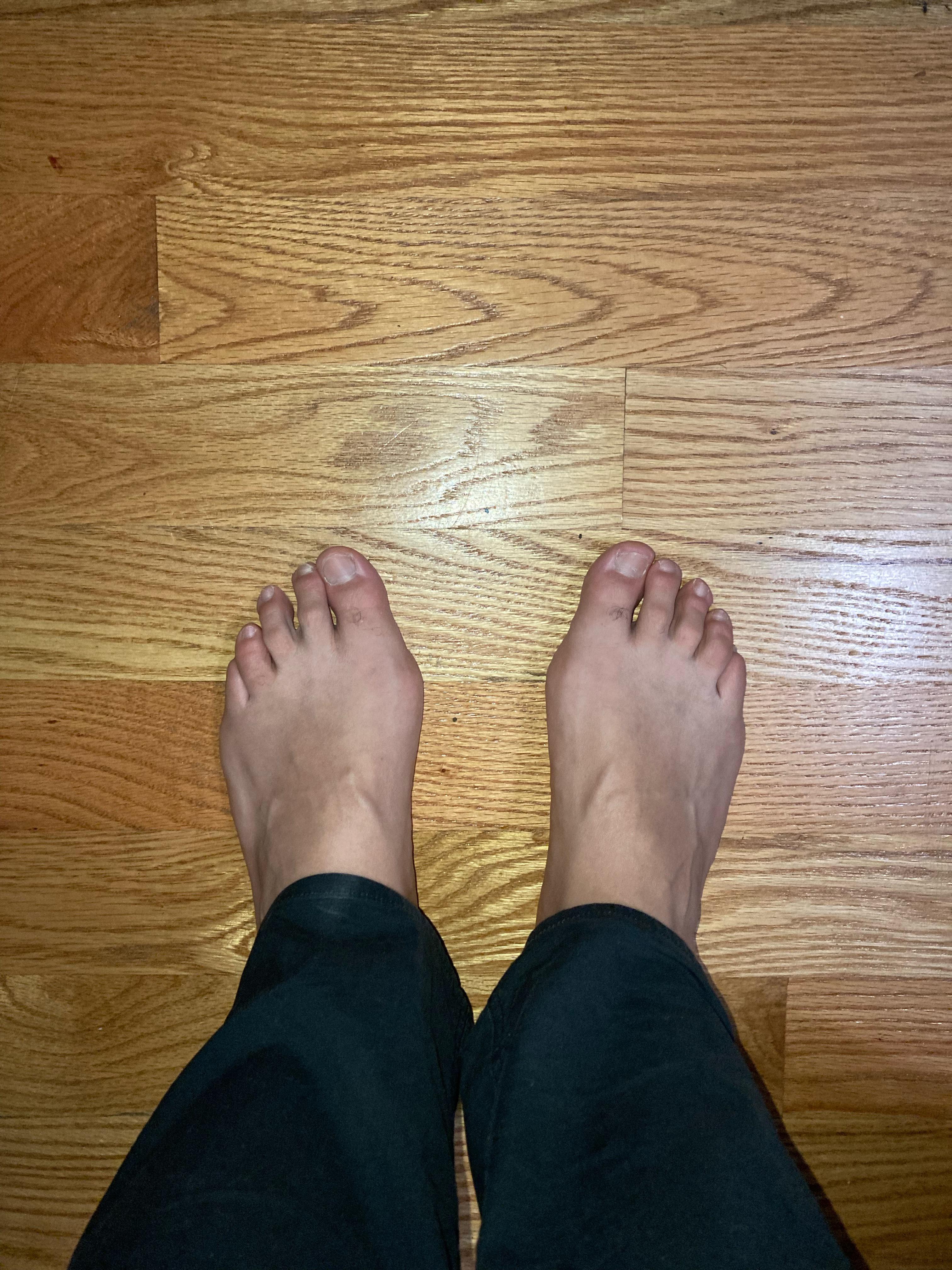 How bad? r/bunions