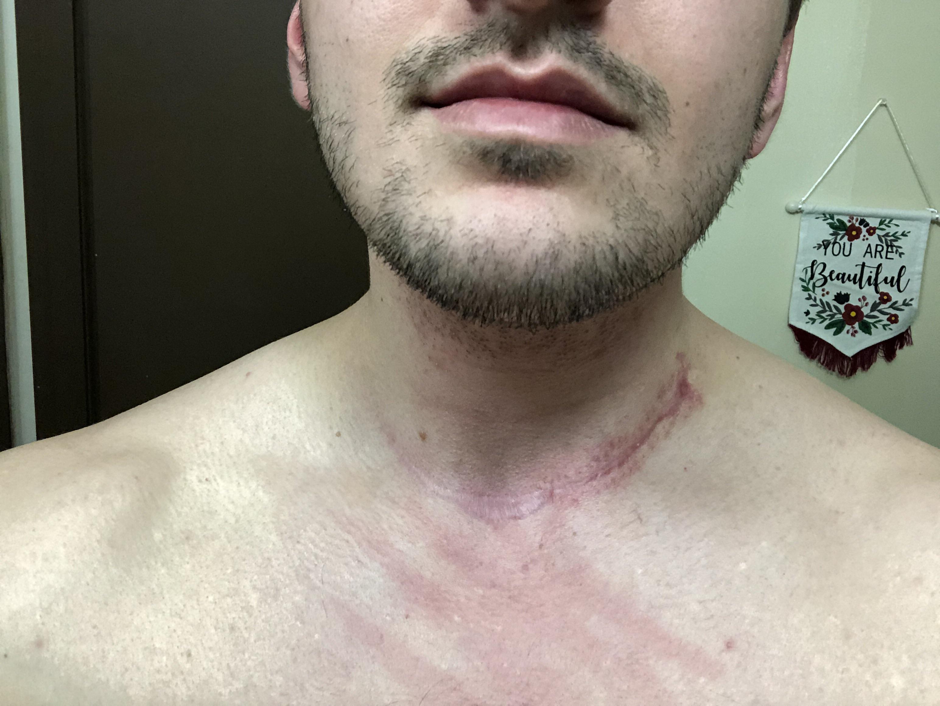 How do you guys think my scar looks? It’s one year post op for the