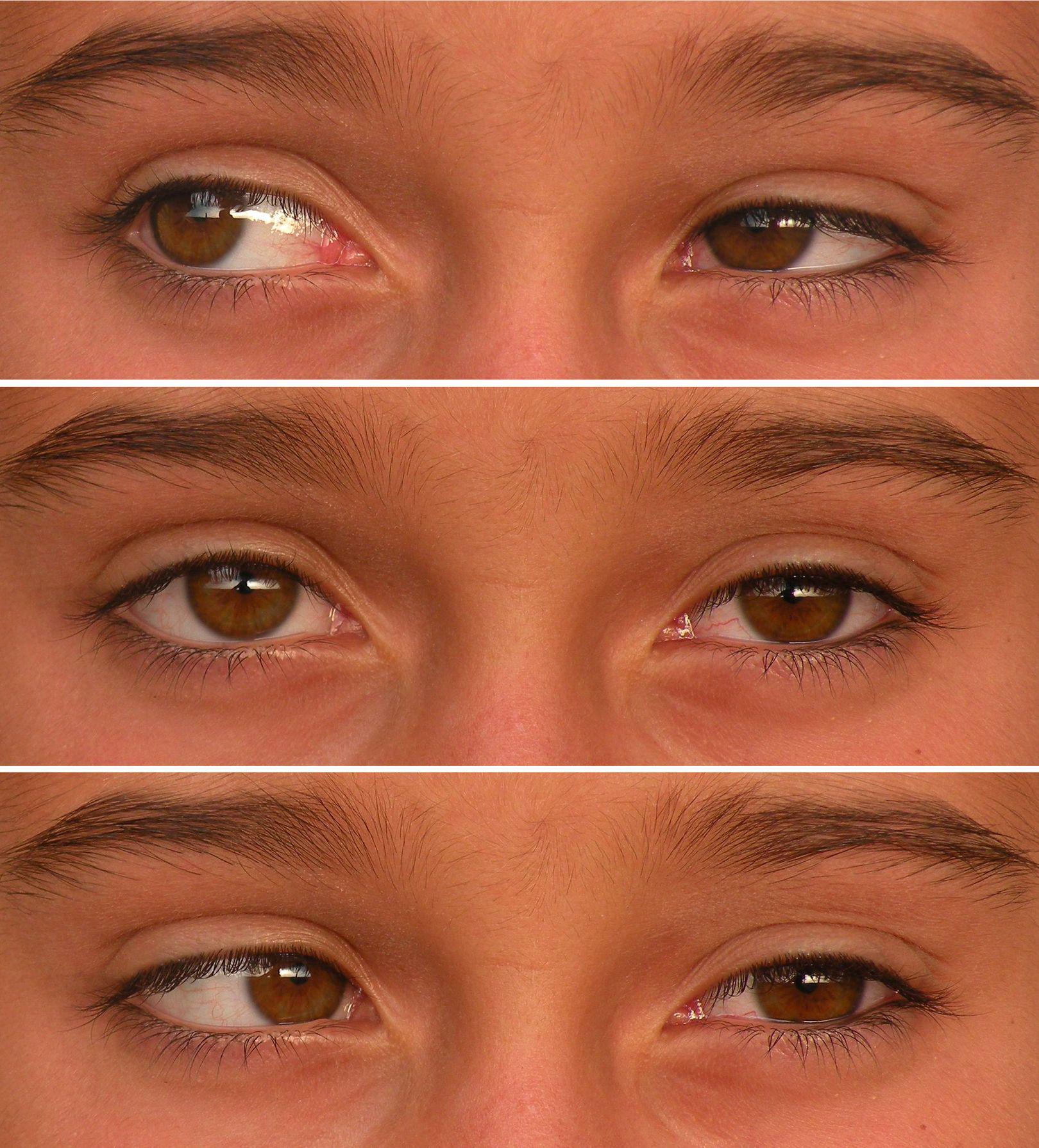 Duane syndrome (DS) is an eye movement disorder present at birth