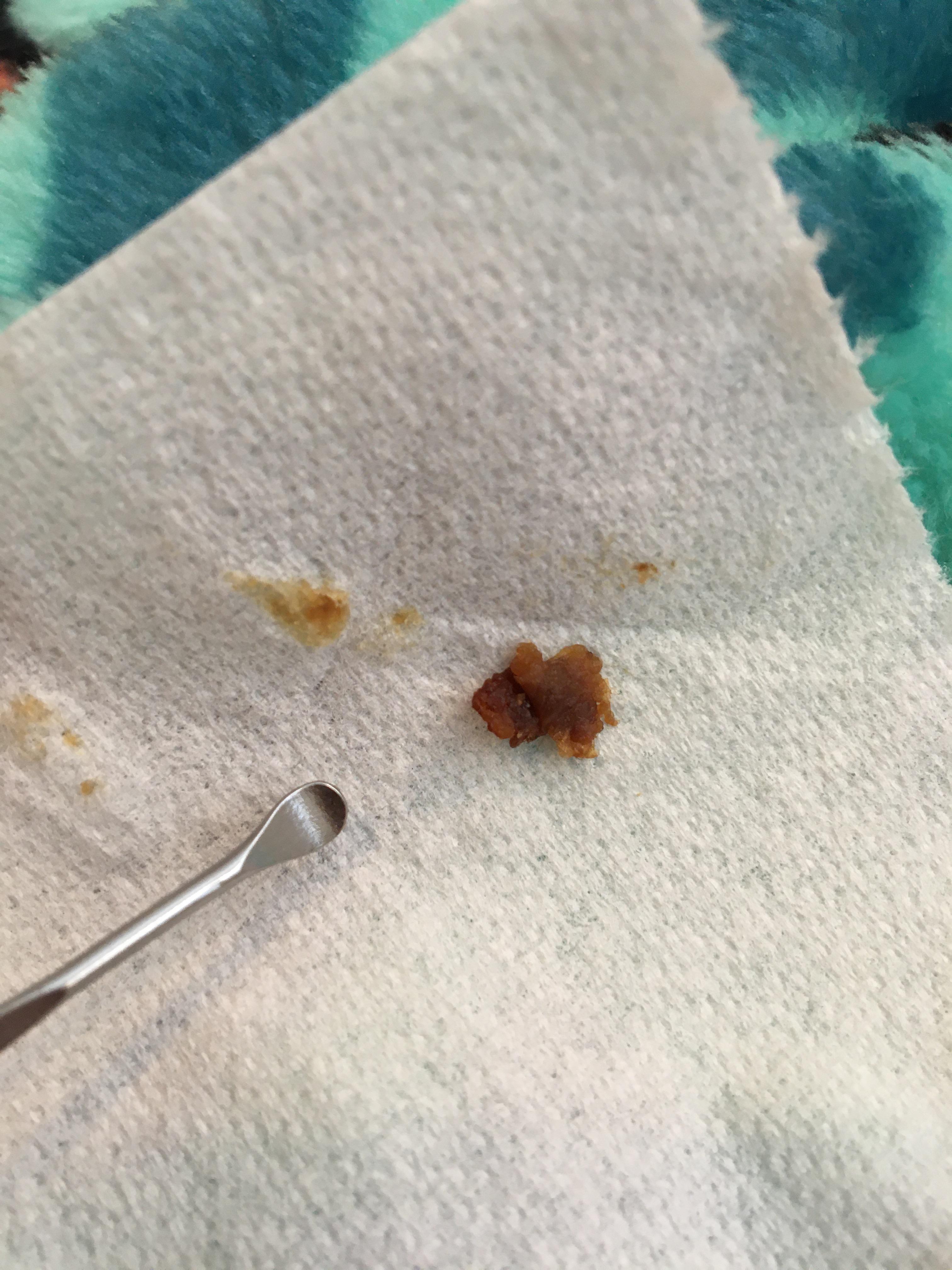 My biggest chunk ever r/earwax
