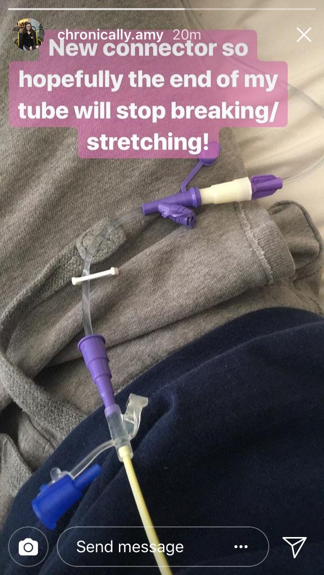 CA’s tube keeps breaking. Do NG tubes usually break this often