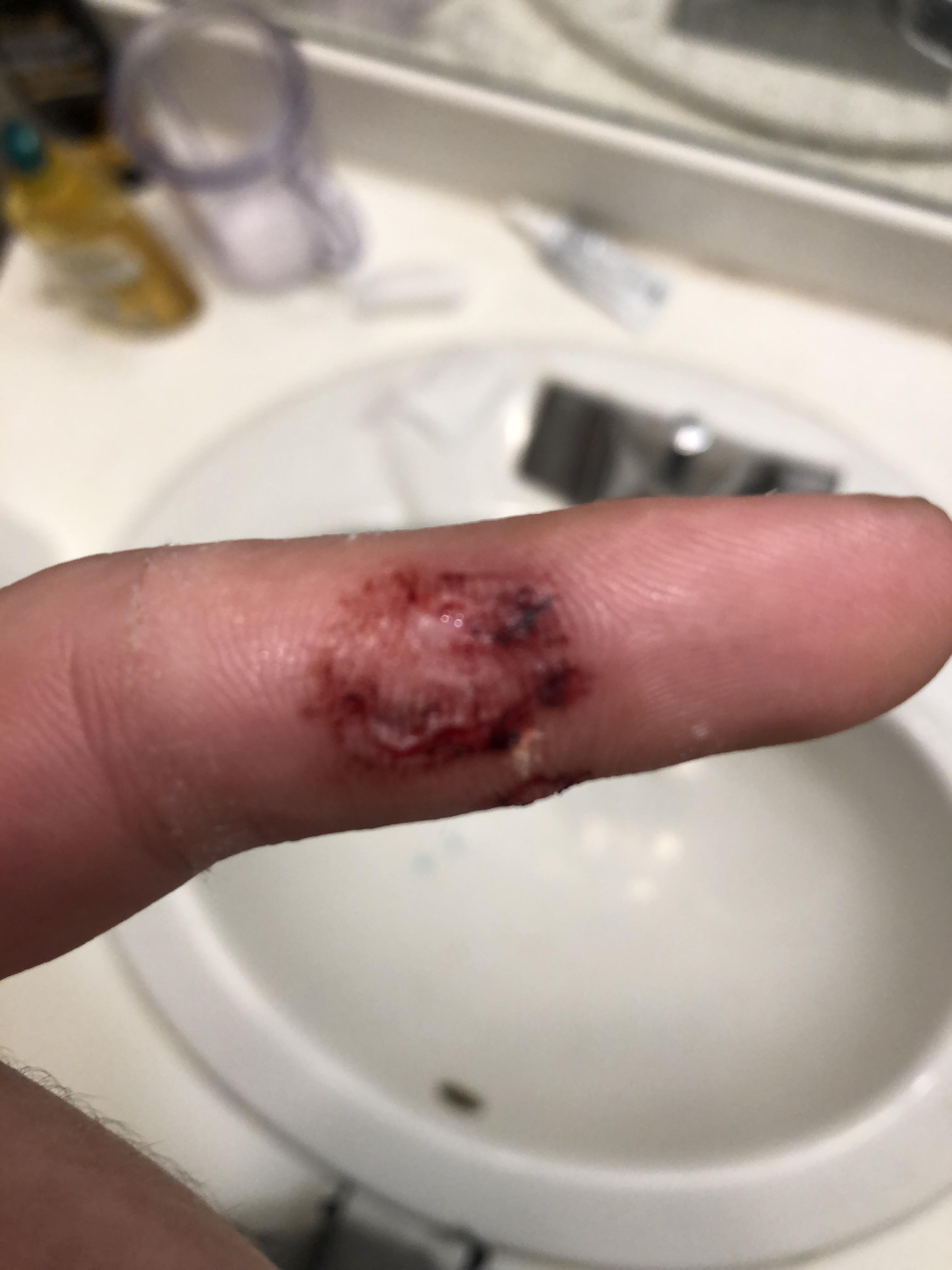 Dog bite. Moved out of state and no insurance what shall I do medical