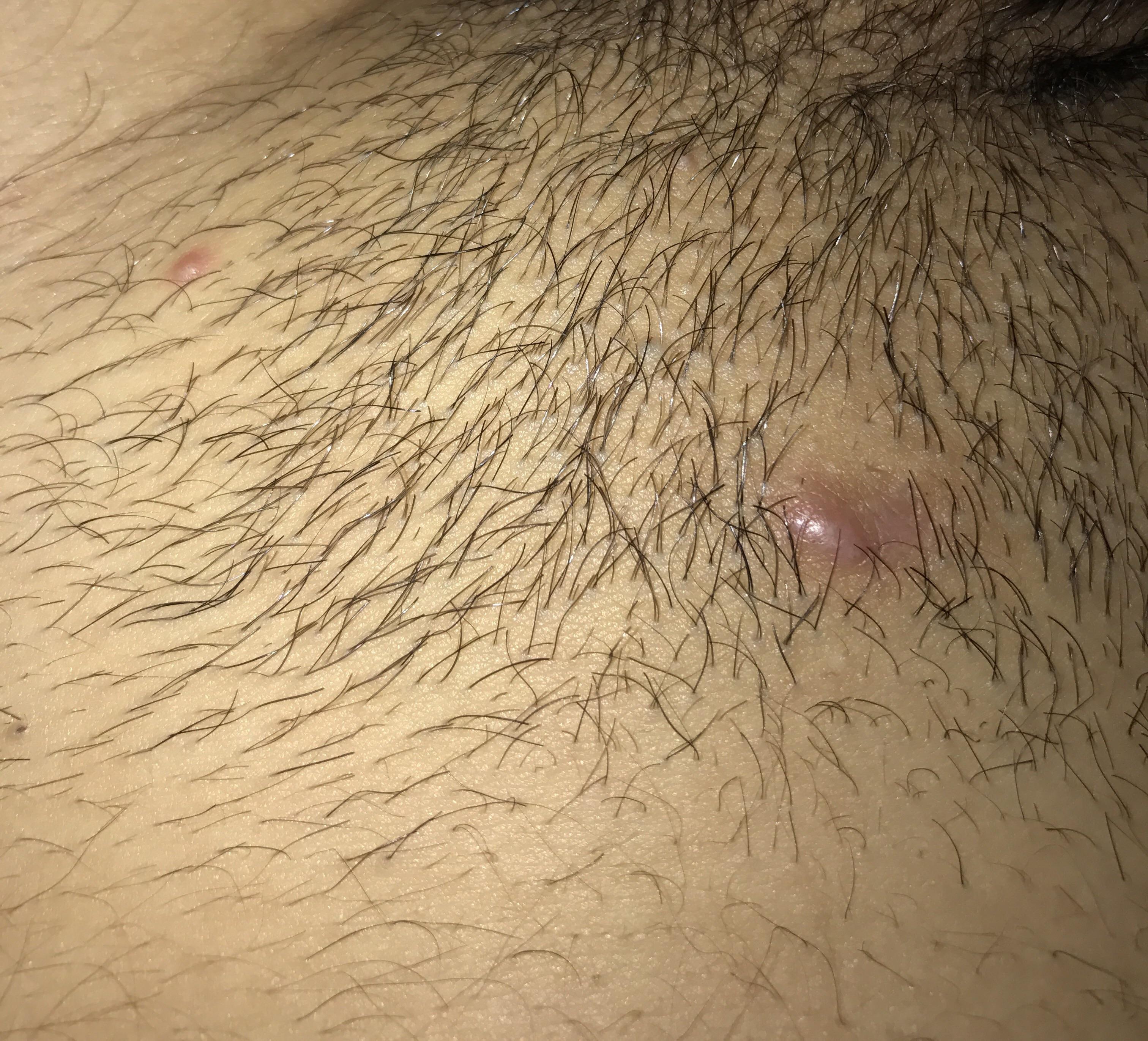 Symptoms Of Ingrown Hair On Vag Ingrown Pubic Hair Treatment And
