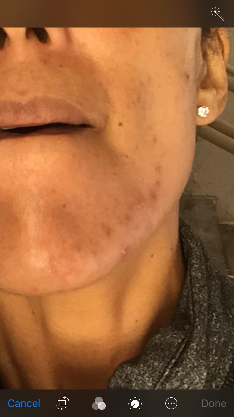 Cystic Acne Hormonal Reddit shearlingwomenbestquality