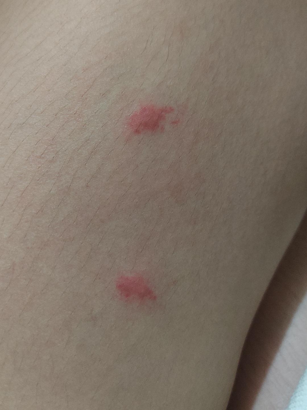 [Skin Concerns] How do i treat these insect bites and minimize scarring