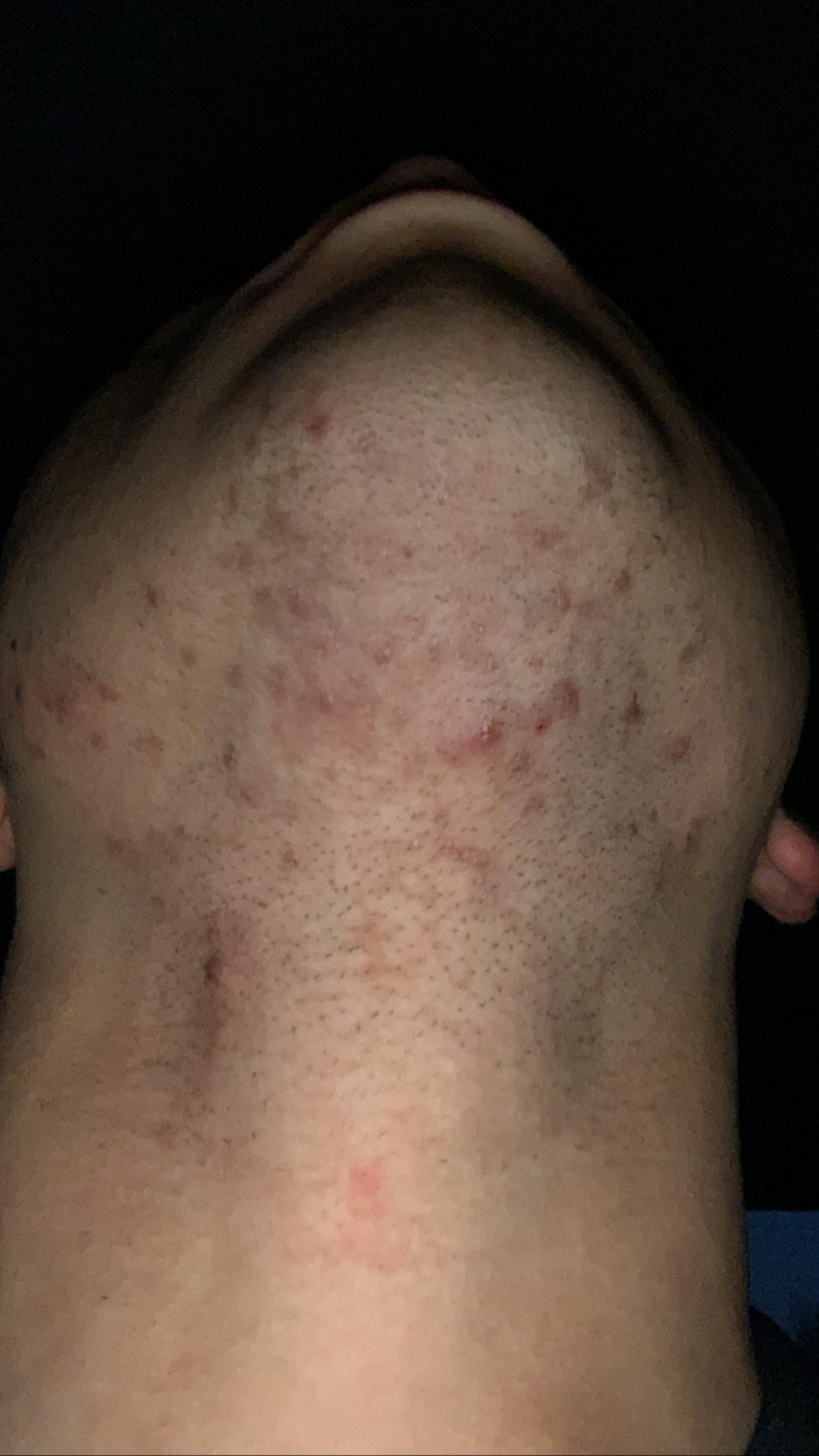 [Skin Concerns] Help. Razor Bumps/ingrown hairs galore. Currently using DE. Have used electric