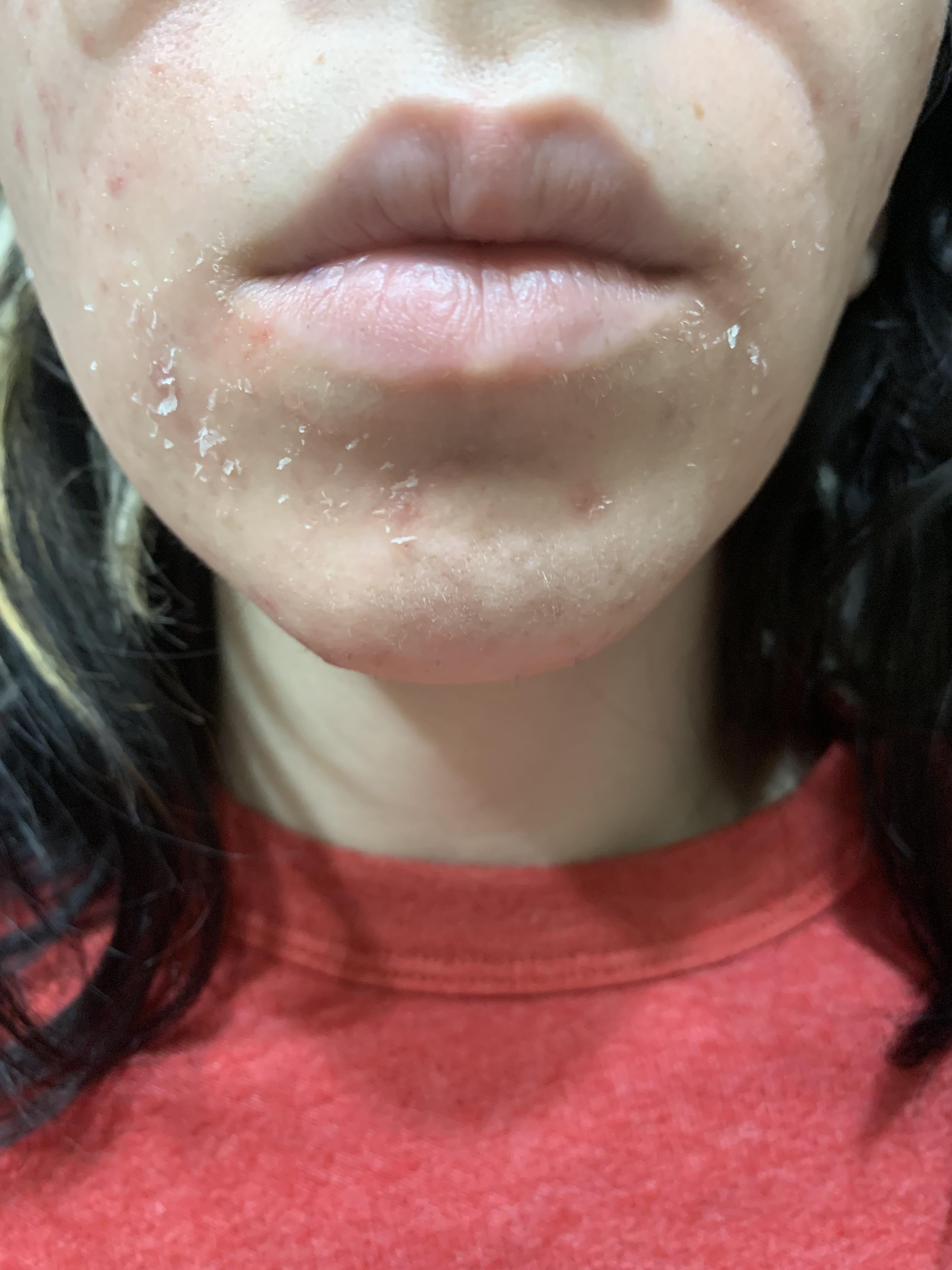[Routine Help] Super dry skin after using prescription cream. r