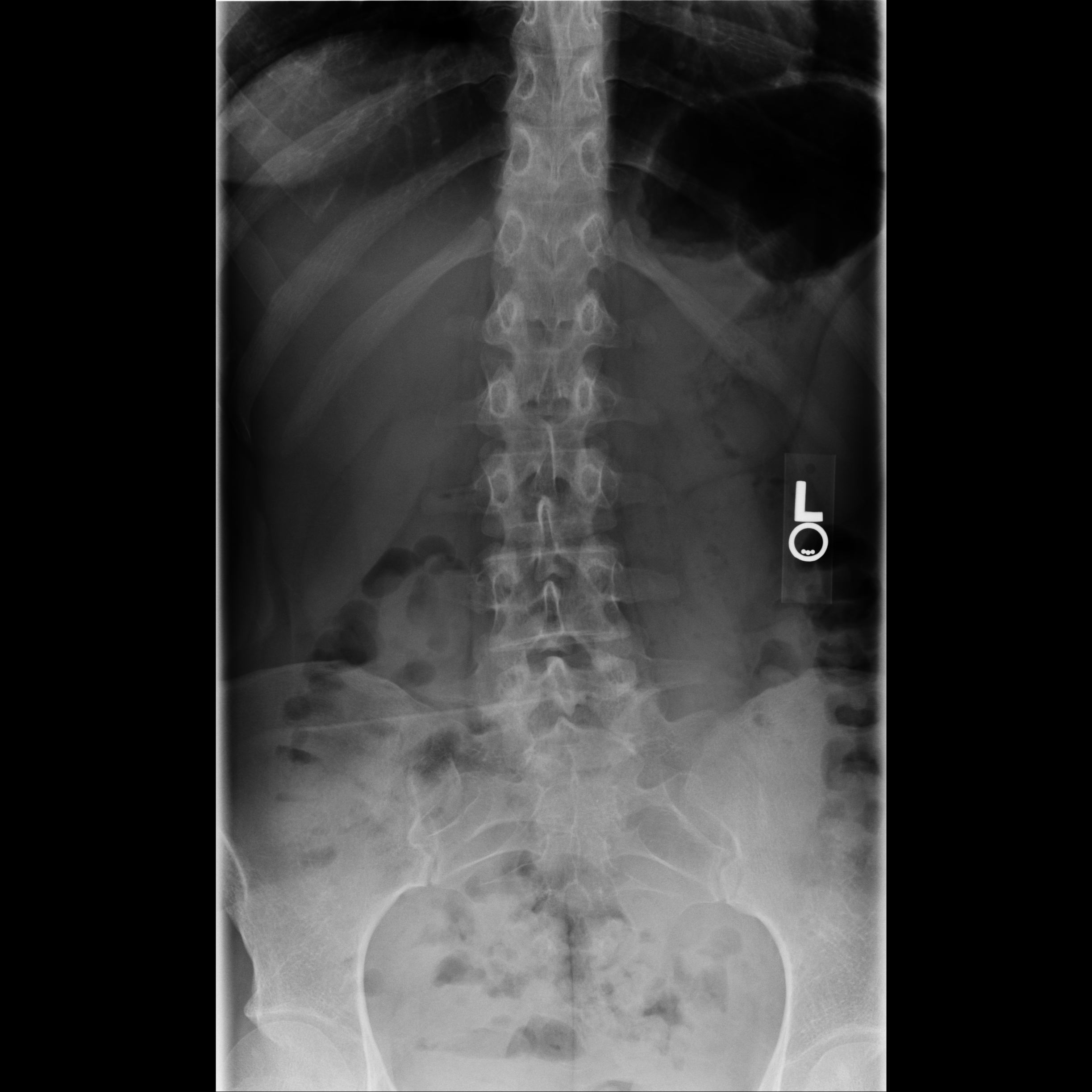 Scoliosis? xrays