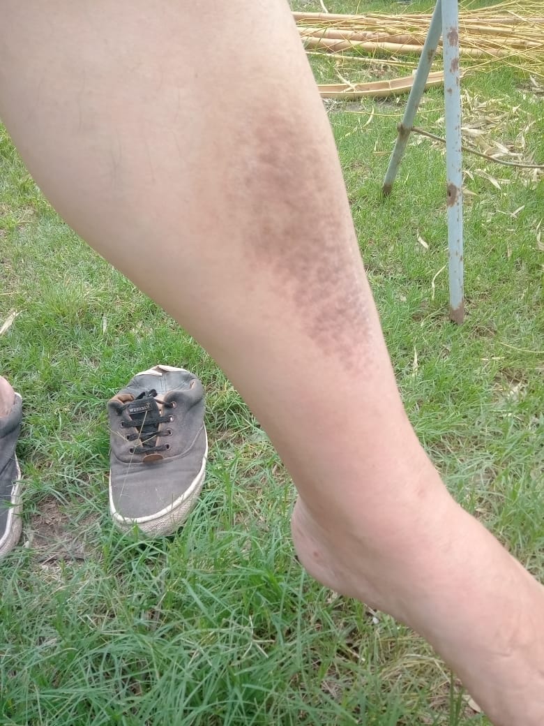 Weird feeling in my leg and strange spots, been like this for a long time any idea what could it