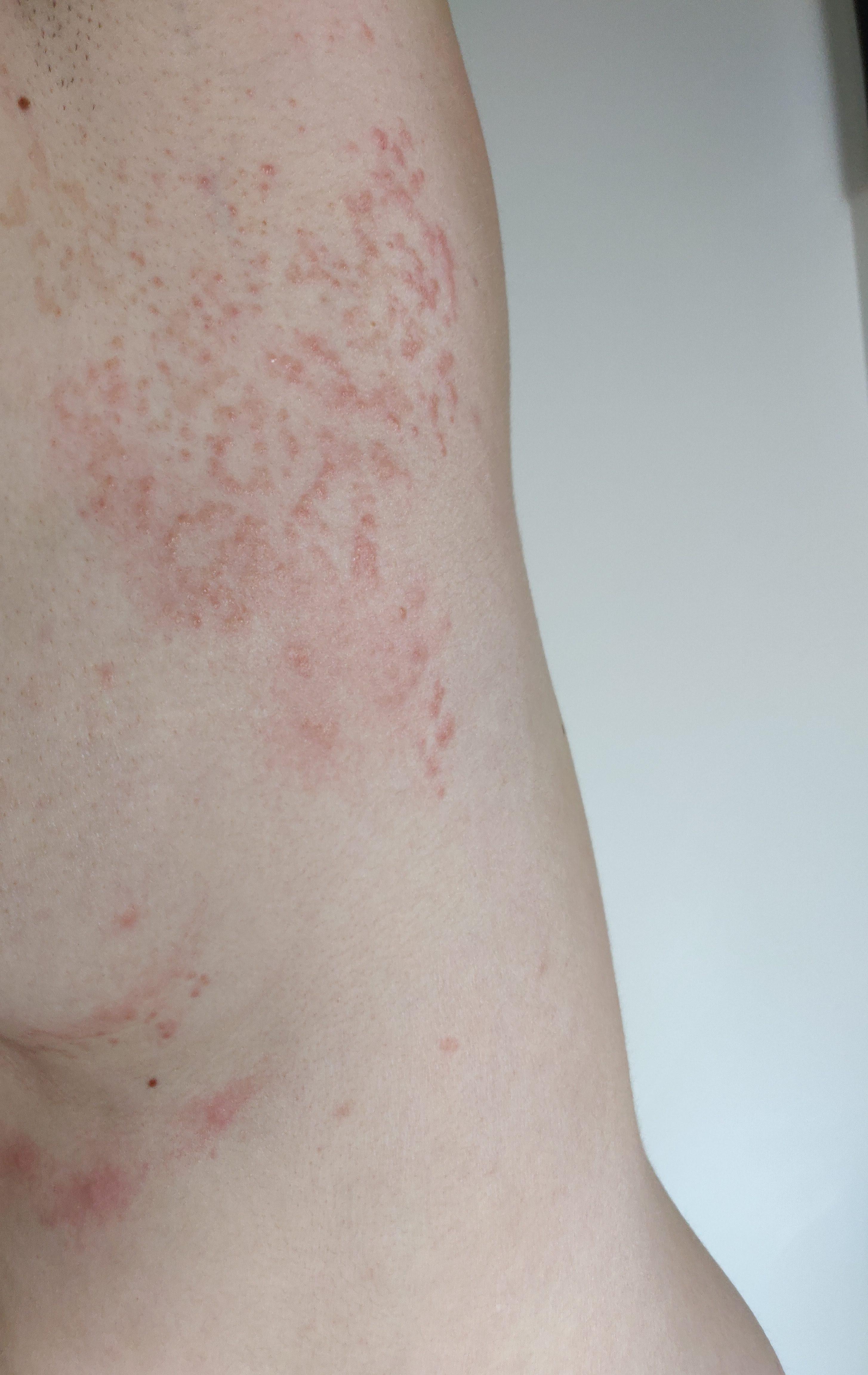 Got this "keto" rash over a year ago. Treated it with black seed oil