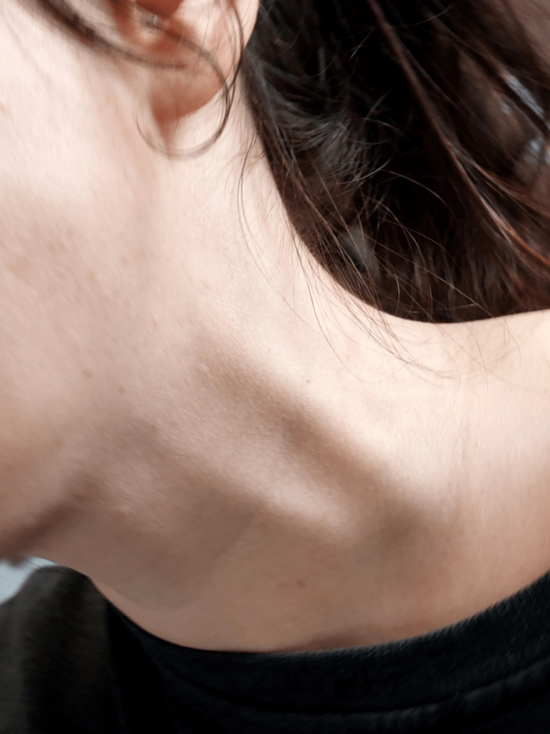 Distension of jugular vein r/medical