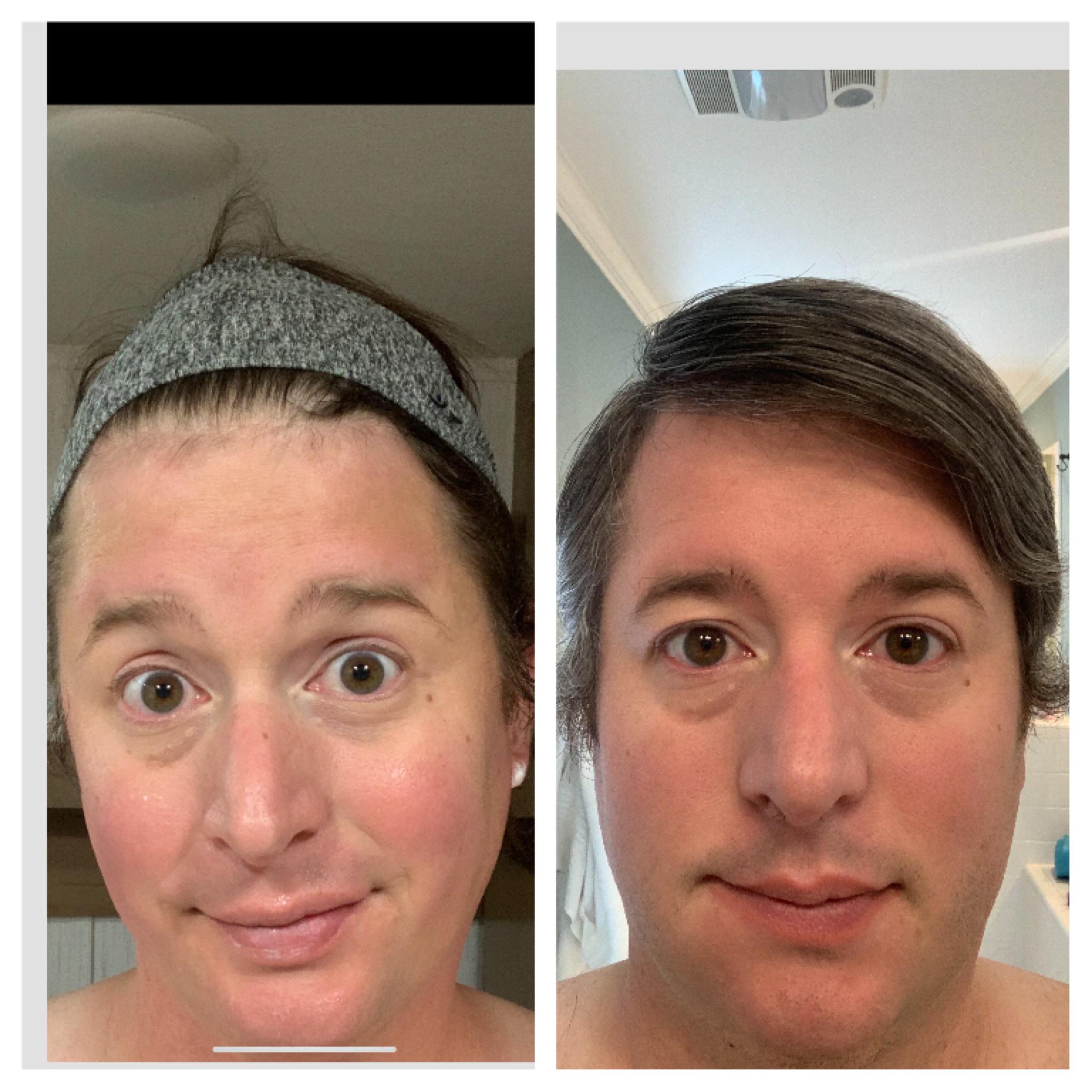 1 year October 15. Estrogen injection, Spiro, Progesterone r