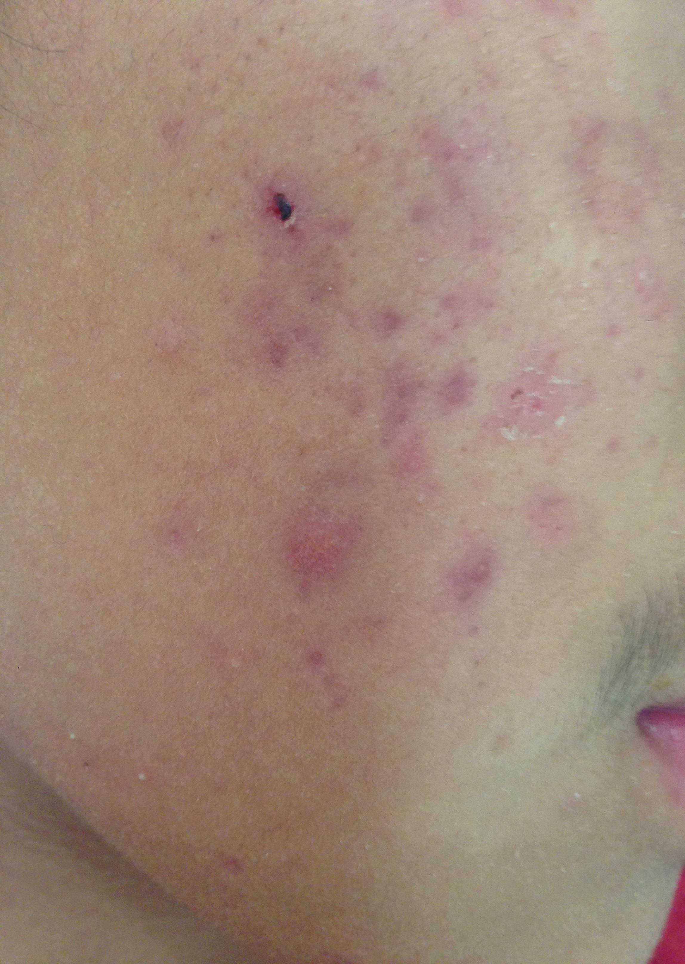 I'm 14 I've had this for a long time now, is this post inflammatory hyperpigmentation? if not