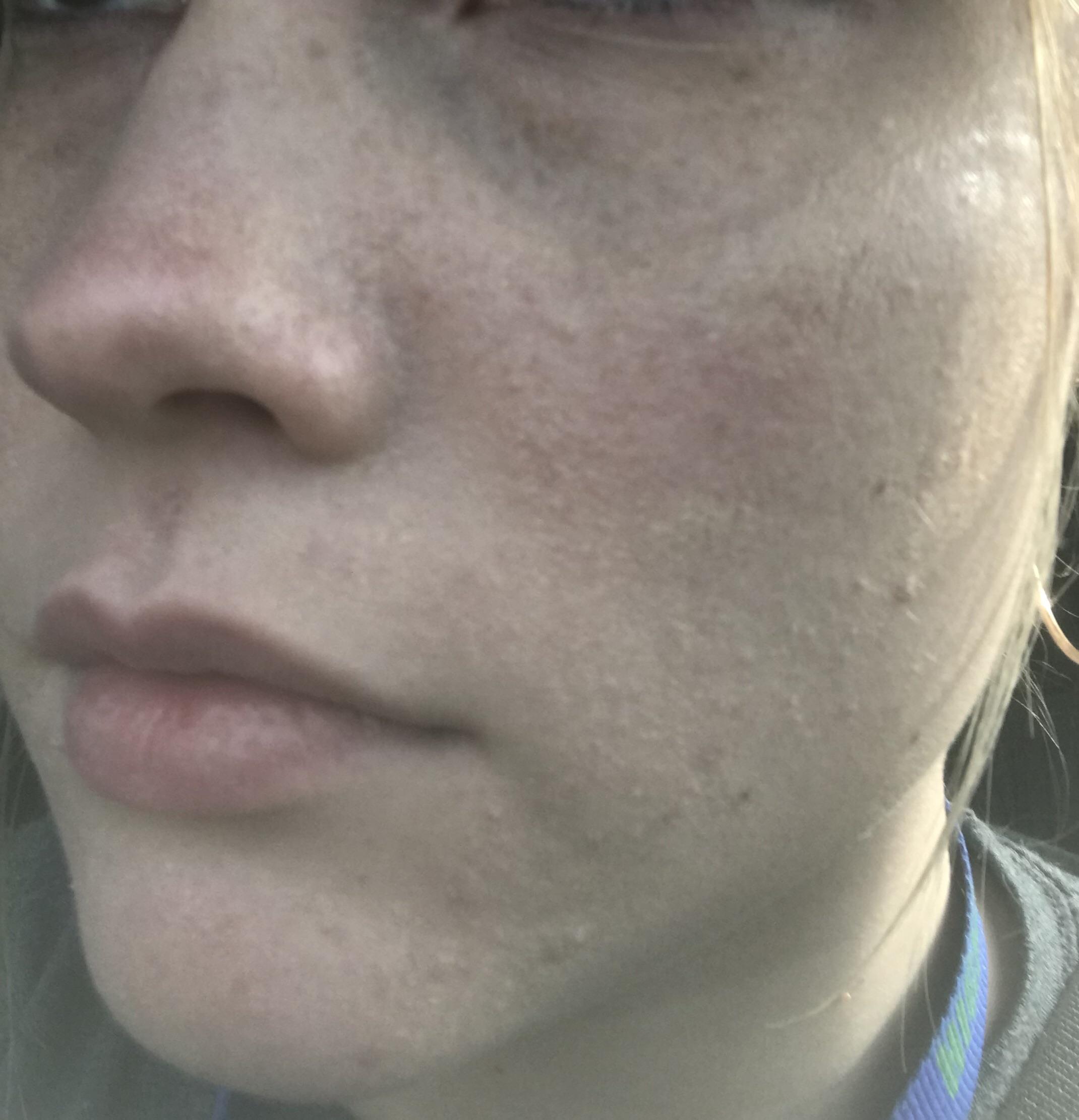 Are these little bumps near my nose/check acne scars? It looks like