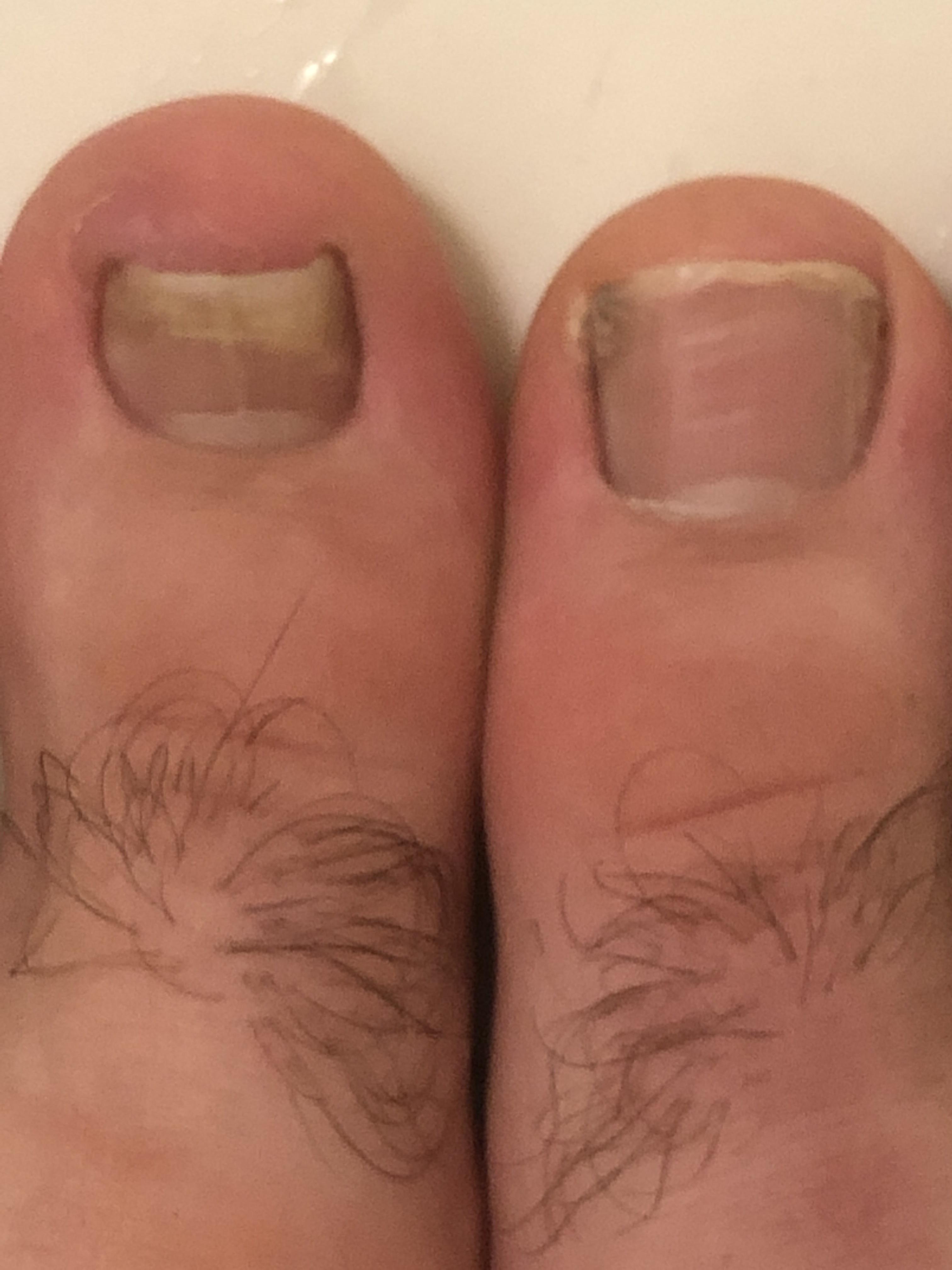 Toenail fell off now top left part is in pain w puss. Going through