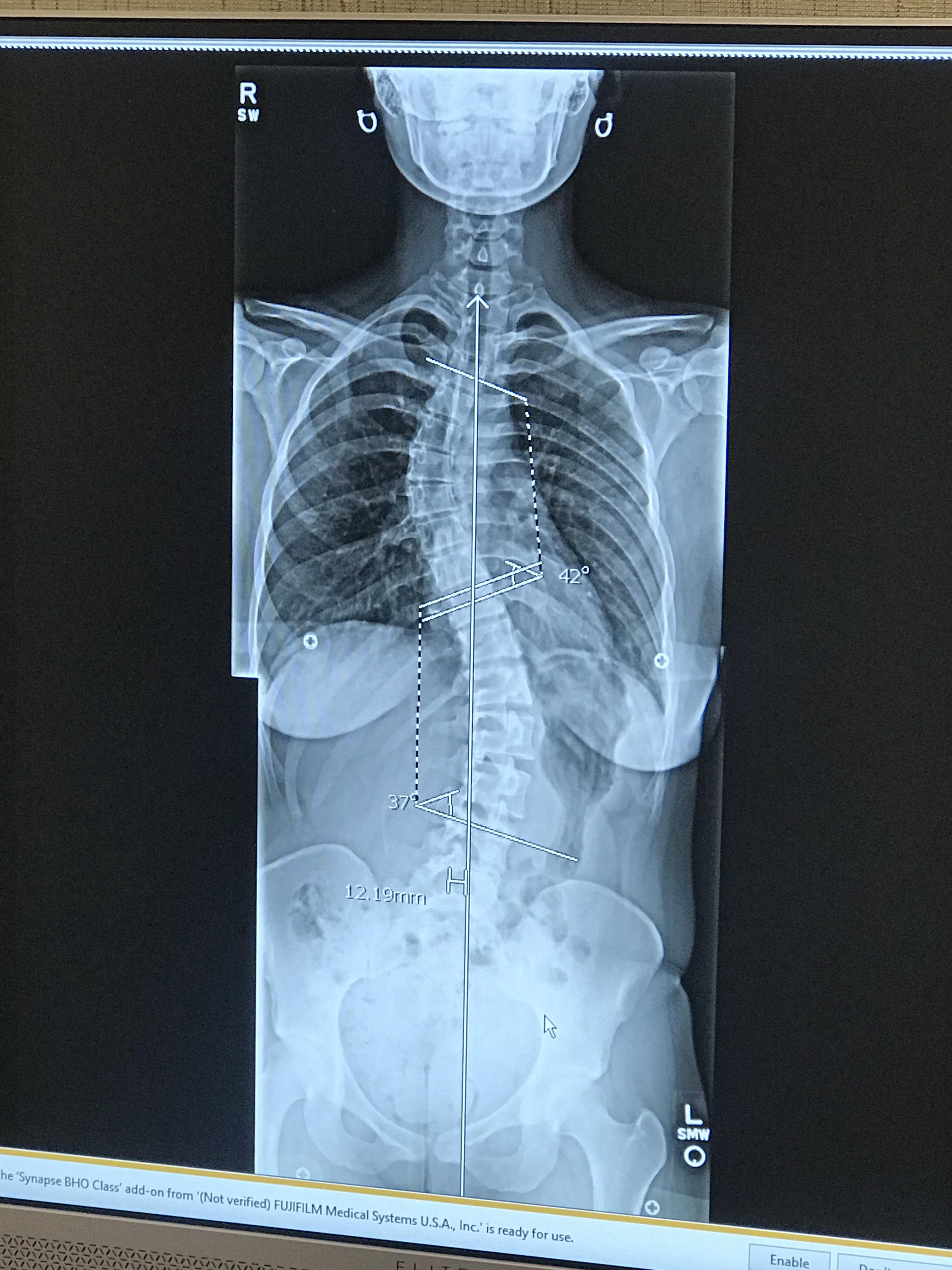 Heart palpitations with scoliosis? scoliosis