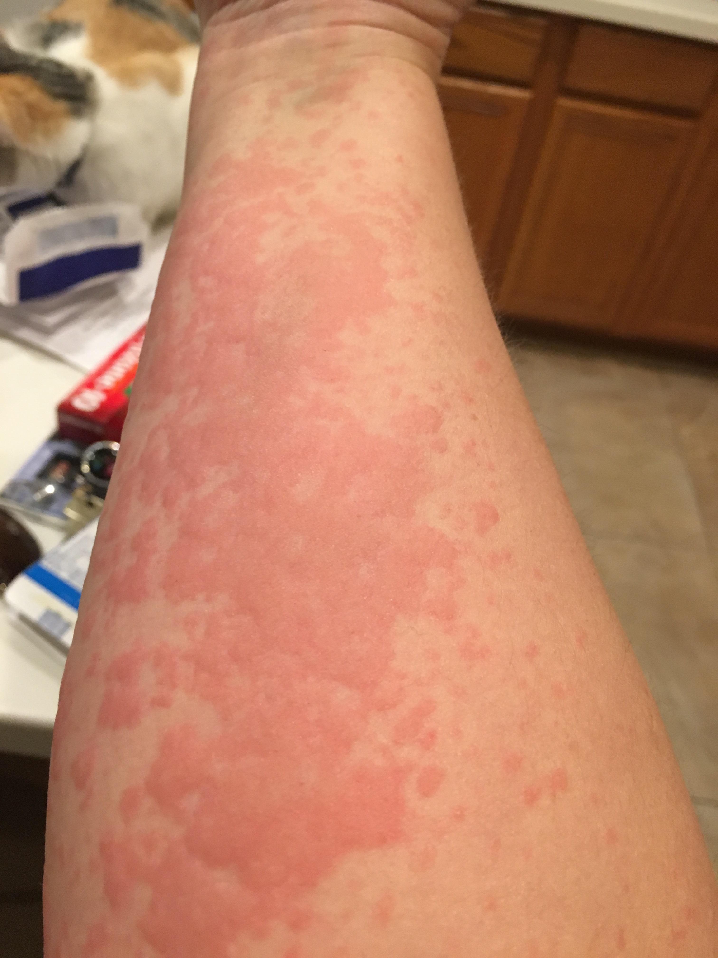 Rash 5 days after flu shot... has anyone else had a