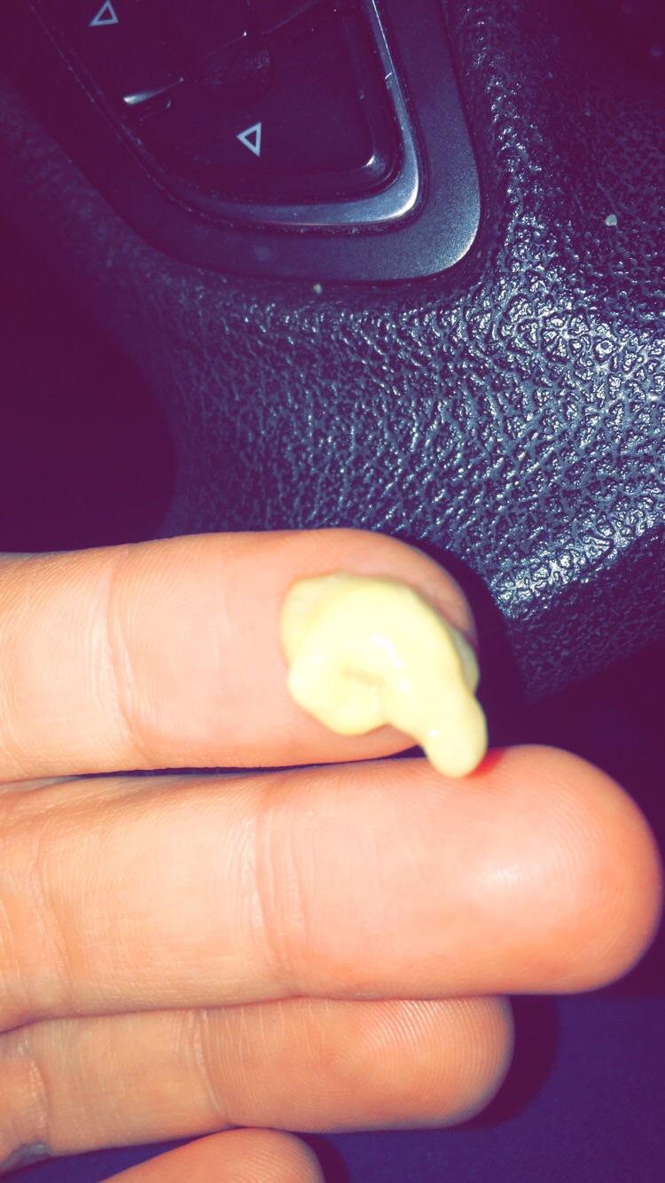 been coughing up thick, NASTY mucus for weeks and this just CAME OUT OF MY MOUTH!!!! should I be
