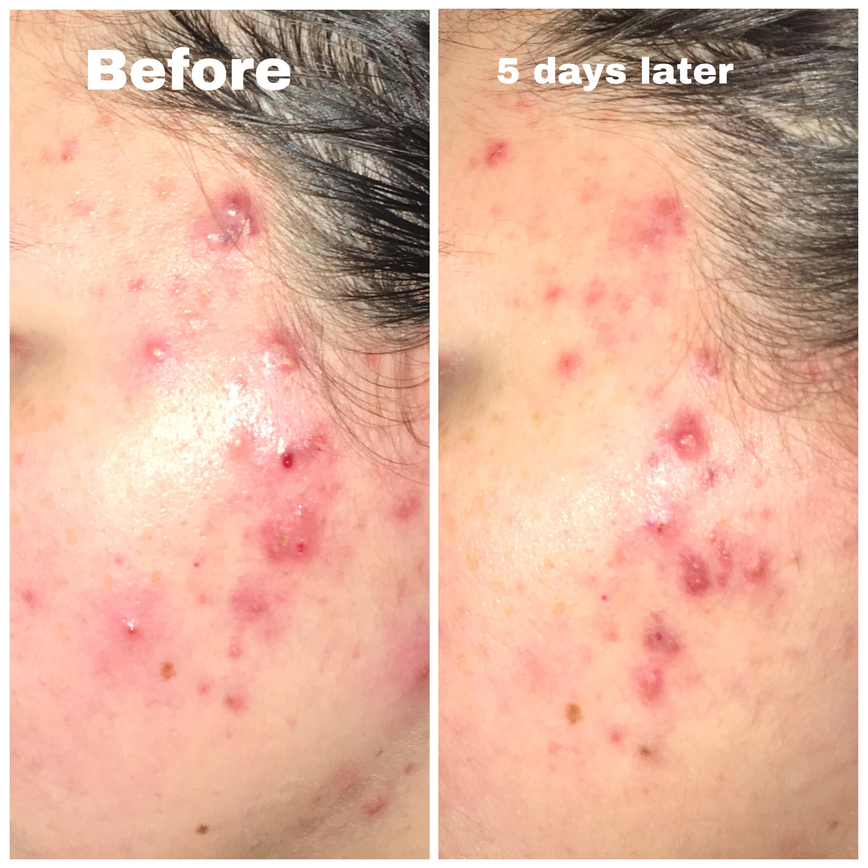 [Acne] I’ve started using stridex pads, cetaphil cleanser, and