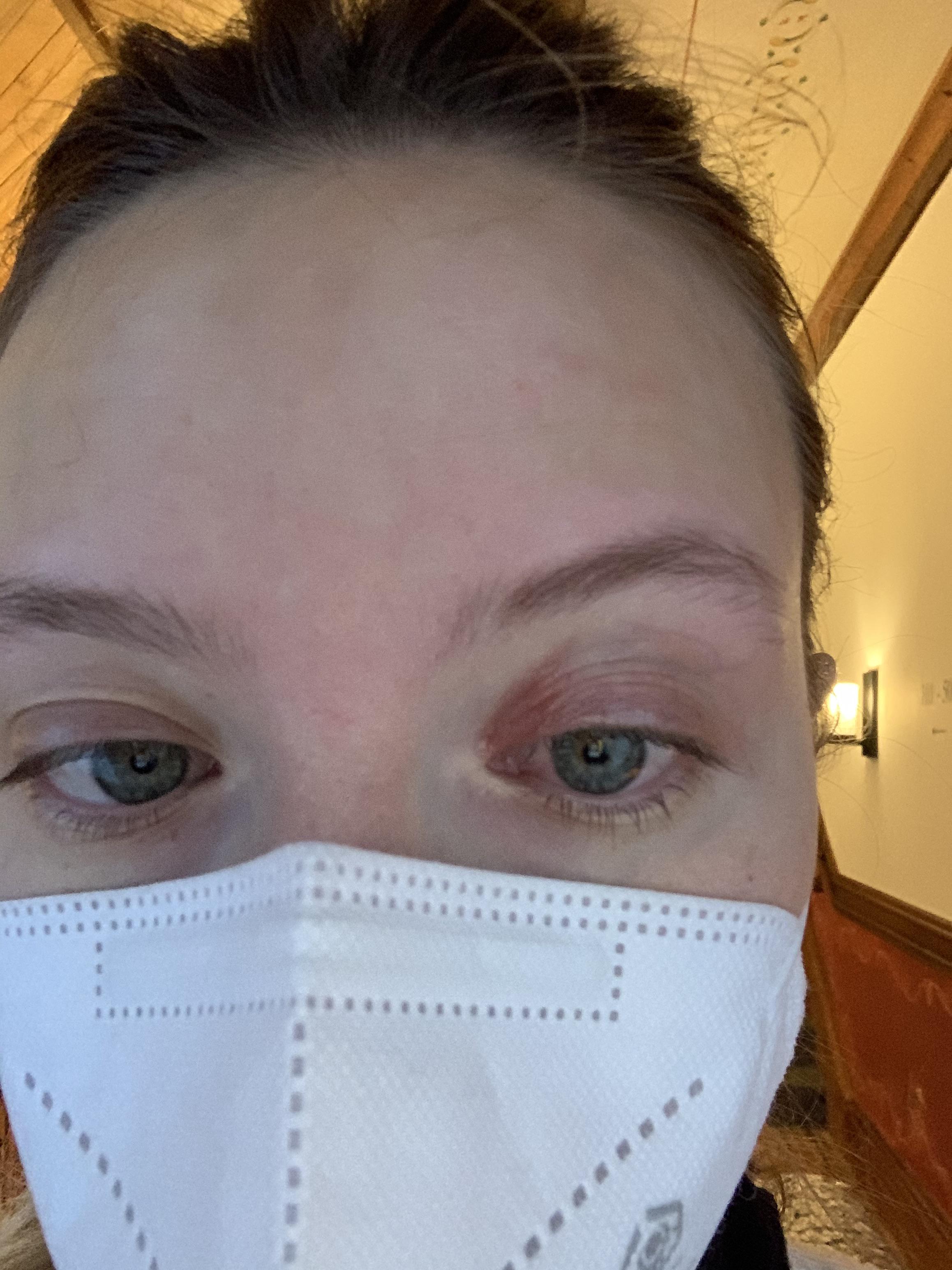 Anyone experience eyes problem while on isotretinoin? 😩 r/Accutane