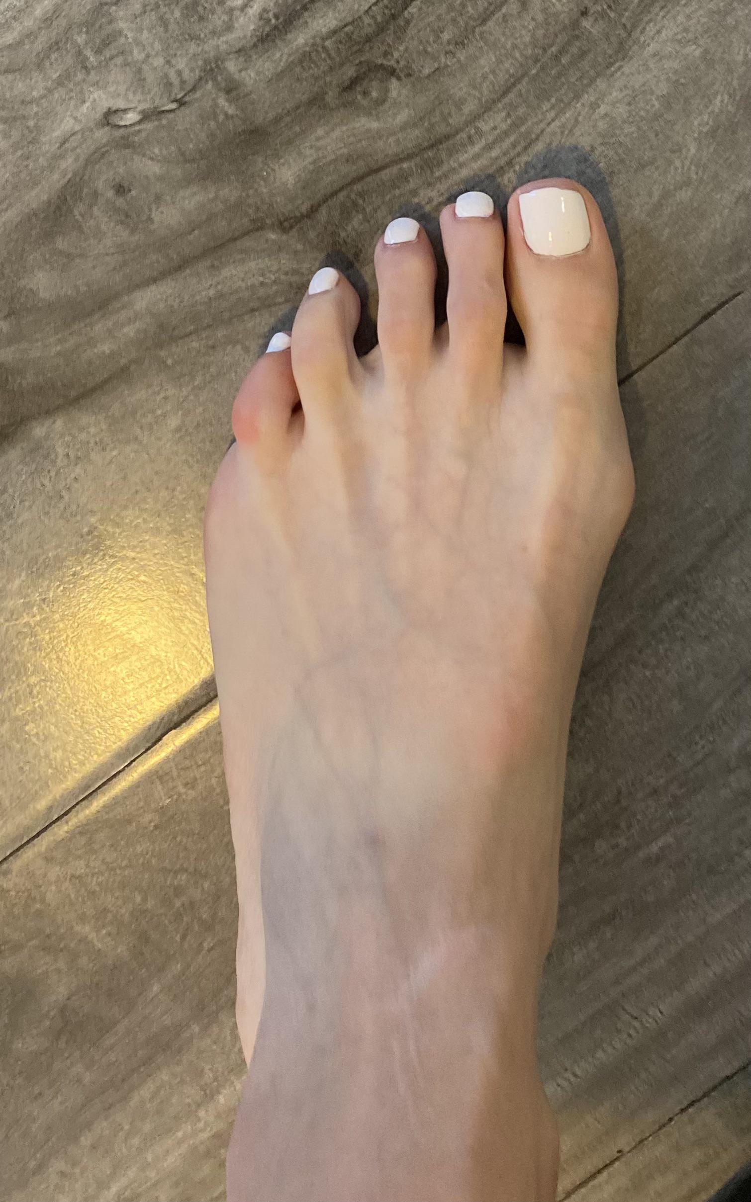 Bunion starting to hurt/get worse saw a doc last year and he didn’t